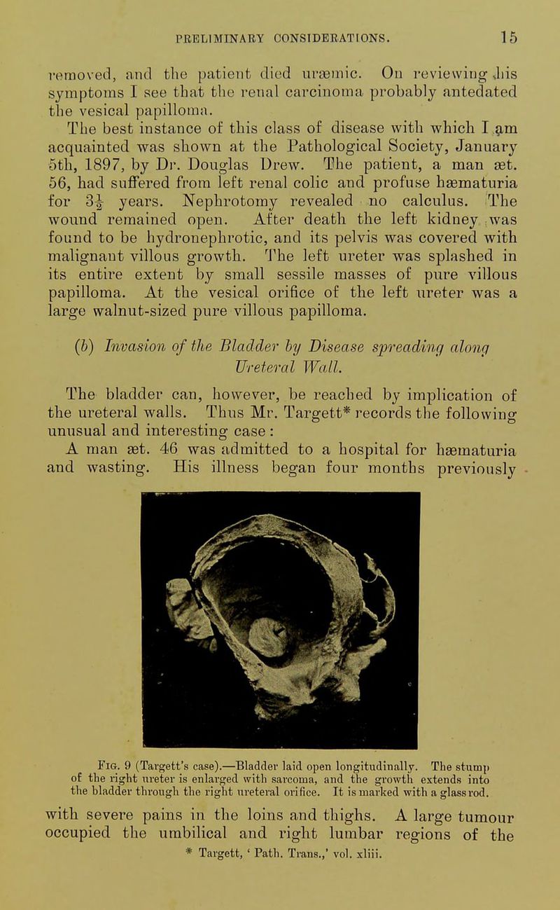 removed, and the patient died uraemic. On reviewing ,his symptoms I see that the renal carcinoma probably antedated the vesical papilloma. The best instance of this class of disease with which I am acquainted was shown at the Pathological Society, January 5th, 1897, by Dr. Douglas Drew. The patient, a man set. 56, had suffered from left renal colic and profuse haematuria for 3-| years. Nephrotomy revealed no calculus. The wound remained open. After death the left kidney was found to be hydronephrotic, and its pelvis was covered with malignant villous growth. The left ureter was splashed in its entire extent by small sessile masses of pure villous papilloma. At the vesical orifice of the left ureter was a large walnut-sized pure villous papilloma. (b) Invasion of the Bladder by Disease spreading along Ureteral Wall. The bladder can, however, be reached by implication of the ureteral walls. Thus Mr. Targett* records the following unusual and interesting case : A man set. 46 was admitted to a hospital for haematuria and wasting. His illness began four months previously - Fig. 9 (Targett's case).—Bladder laid open longitudinally. The stump of the right ureter is enlarged with sarcoma, and the growth extends into the bladder through the right ureteral orifice. It is marked with a glass rod. with severe pains in the loins and thighs. A large tumour occupied the umbilical and right lumbar regions of the * Targett, ' Path. Trans.,' vol. xliii.