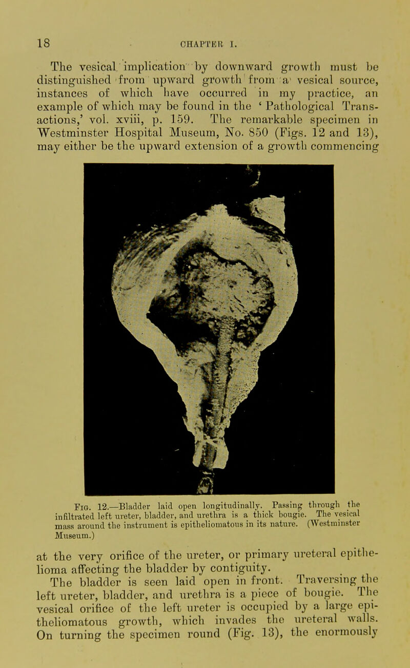 The vesical, implication by downward growth must be distinguished from upward growth from a' vesical source, instances of which have occurred in my practice, an example of which may be found in the ' Pathological Trans- actions,' vol. xviii, p. 159. The remarkable specimen in Westminster Hospital Museum, No. 850 (Figs. 12 and 13), may either be the upward extension of a growth commencing Fig. 12—Bladder laid open longitudinally. Passing through the infiltrated left ureter, bladder, and urethra is a thick bougie. The vesical mass around the instrument is epithelioinatous in its nature. (Westminster Museum.) at the very orifice of the ureter, or primary ureteral epithe- lioma affecting the bladder by contiguity. The bladder is seen laid open in front. Traversing the left ureter, bladder, and urethra is a piece of bougie. The vesical orifice of the left ureter is occupied by a large epi- theliomatous growth, which invades the ureteral walls. On turning the specimen round (Fig. 13), the enormously