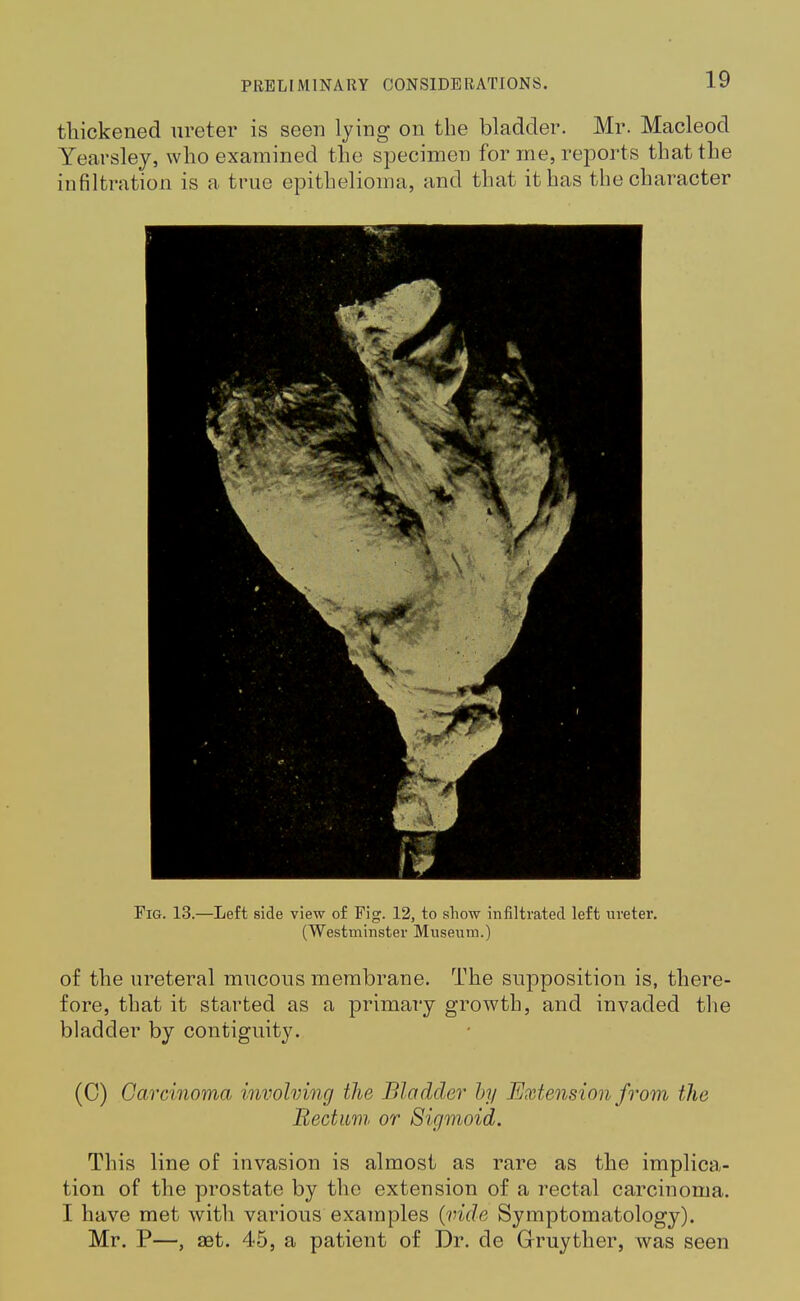 thickened ureter is seen lying on the bladder. Mr. Macleod Yearsley, who examined the specimen for me, reports that the infiltration is a true epithelioma, and that it has the character Fig. 13.—Left side view of Fig. 12, to show infiltrated left ureter. (Westminster Museum.) of the ureteral mucous membrane. The supposition is, there- fore, that it started as a primary growth, and invaded the bladder by contiguity. (C) Carcinoma involving the Bladder hy Extension from the Rectum or Sigmoid. This line of invasion is almost as rare as the implica- tion of the prostate by the extension of a rectal carcinoma. I have met with various examples (vide Symptomatology). Mr. P—, ast. 45, a patient of Dr. de Gruyther, was seen