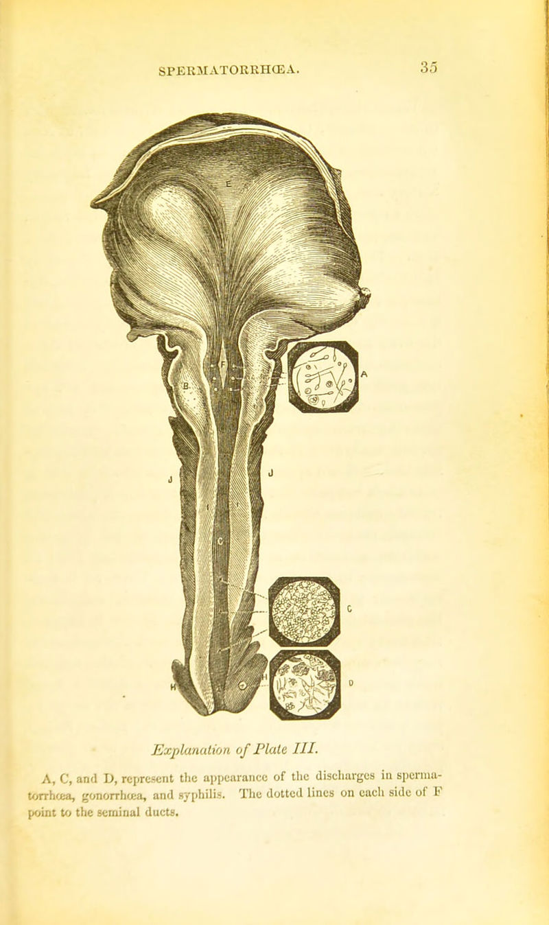 Explanation of Plate III. A, C, and D, represent the appearance of the discharges in sperma- torrhoea, gonorrhoea, and syphilis. The dotted lines on each side of F point to the seminal ducts.