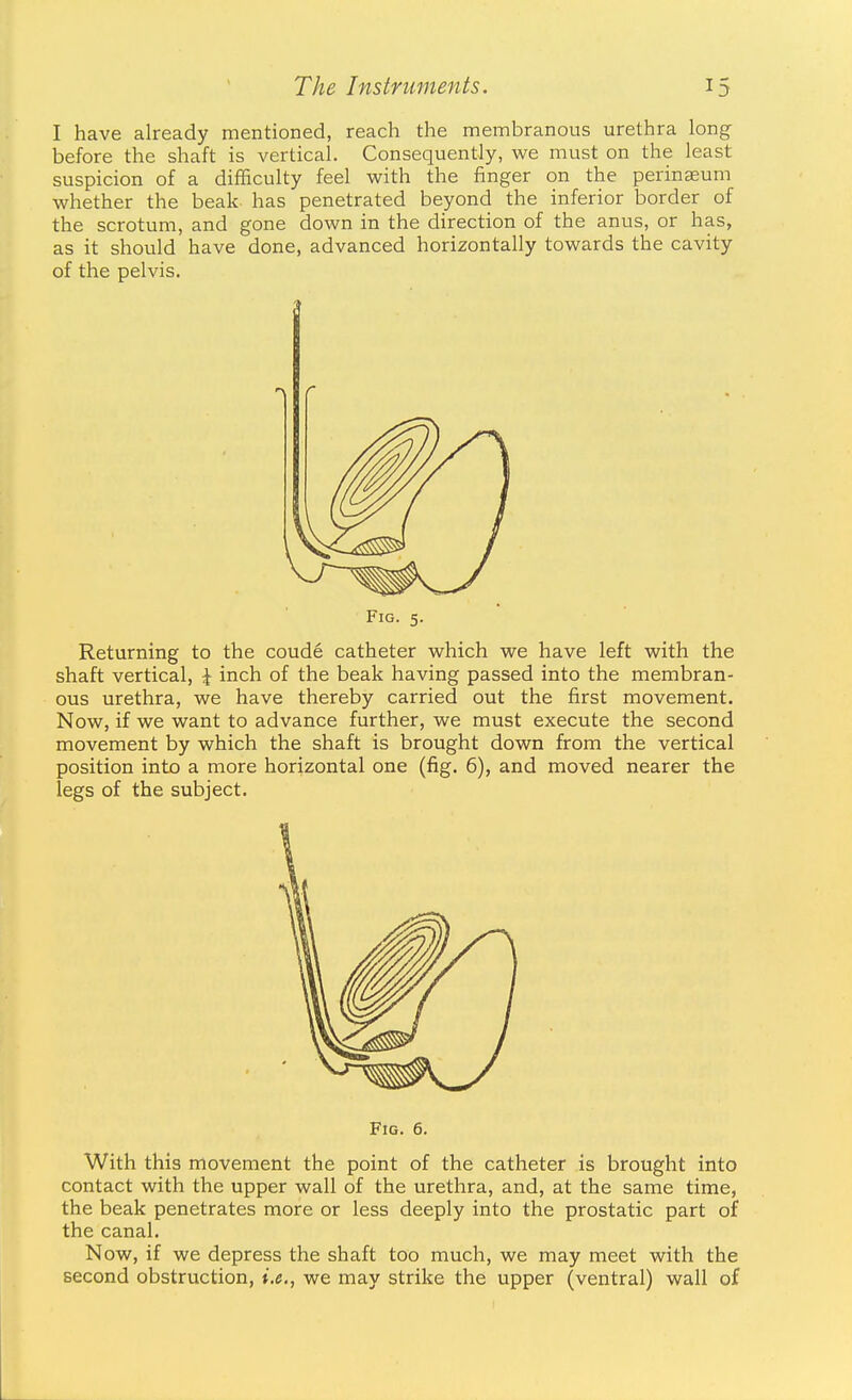 I have already mentioned, reach the membranous urethra long before the shaft is vertical. Consequently, we must on the least suspicion of a difficulty feel with the finger on the perinEEum whether the beak has penetrated beyond the inferior border of the scrotum, and gone down in the direction of the anus, or has, as it should have done, advanced horizontally towards the cavity of the pelvis. Returning to the coude catheter which we have left with the shaft vertical, \ inch of the beak having passed into the membran- ous urethra, we have thereby carried out the first movement. Now, if we want to advance further, we must execute the second movement by which the shaft is brought down from the vertical position into a more horizontal one (fig. 6), and moved nearer the legs of the subject. With this movement the point of the catheter is brought into contact with the upper wall of the urethra, and, at the same time, the beak penetrates more or less deeply into the prostatic part of the canal. Now, if we depress the shaft too much, we may meet with the second obstruction, i.e., we may strike the upper (ventral) wall of r Fig. 5.