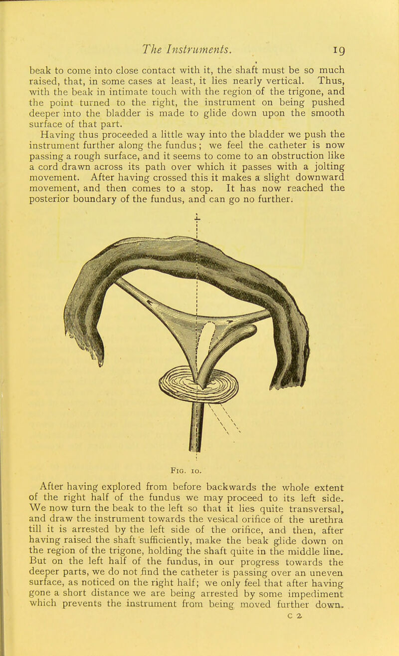 beak to come into close contact with it, the shaft must be so much raised, that, in some cases at least, it lies nearly vertical. Thus, with the beak in intimate touch with the region of the trigone, and the point turned to the right, the instrument on being pushed deeper into the bladder is made to glide down upon the smooth surface of that part. Having thus proceeded a little way into the bladder we push the instrument further along the fundus; we feel the catheter is now passing a rough surface, and it seems to come to an obstruction like a cord drawn across its path over which it passes with a jolting movement. After having crossed this it makes a slight downward movement, and then comes to a stop. It has now reached the posterior boundary of the fundus, and can go no further. After having explored from before backwards the whole extent of the right half of the fundus we may proceed to its left side. We now turn the beak to the left so that it Ues quite transversal, and draw the instrument towards the vesical orifice of the urethra till it is arrested by the left side of the orifice, and then, after having raised the shaft sufficiently, make the beak glide down on the region of the trigone, holding the shaft quite in the middle Hne. But on the left half of the fundus, in our progress towards the deeper parts, we do not find the catheter is passing over an uneven surface, as noticed on the right half; we only feel that after having gone a short distance we are being arrested by some impediment which prevents the instrument from being moved further down. c z