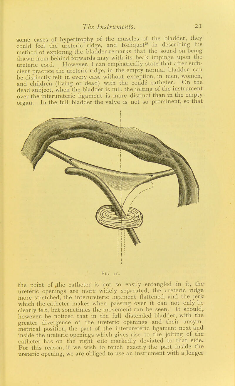 some cases of hypertrophy of the muscles of the bladder, they could feel the ureteric ridge, and Reliquet'^ in describing his method of exploring the bladder remarks that the sound on bemg drawn from behind forwards may with its beak impinge upon the ureteric cord. However, 1 can emphatically state that after suffi- cient practice the ureteric ridge, in the empty normal bladder, can be distinctly felt in every case without exception, in men, women, and children (living or dead) with the coude catheter. On the dead subject, when the bladder is full, the jolting of the instrument over the interureteric ligament is more distinct than in the empty organ. In the full bladder the valve is not so prominent, so that Fig It.- the point of .the catheter is not so easily entangled in it, the ureteric openings are more widely separated, the ureteric ridge- more stretched, the interureteric ligament flattened, and the jerk which the catheter makes when passing over it can not only be clearly felt, but sometimes the movement can be seen. It should^ however, be noticed that in the full distended bladder, with the greater divergence of the ureteric openings and their unsym- metrical position, the part of the interureteric ligament next and inside the ureteric openings which gives rise to the jolting of the catheter has on the right side markedly deviated to that side. For this reason, if we wish to touch exactly the part inside the ureteric opening, we are obliged to use an instrument with a longer