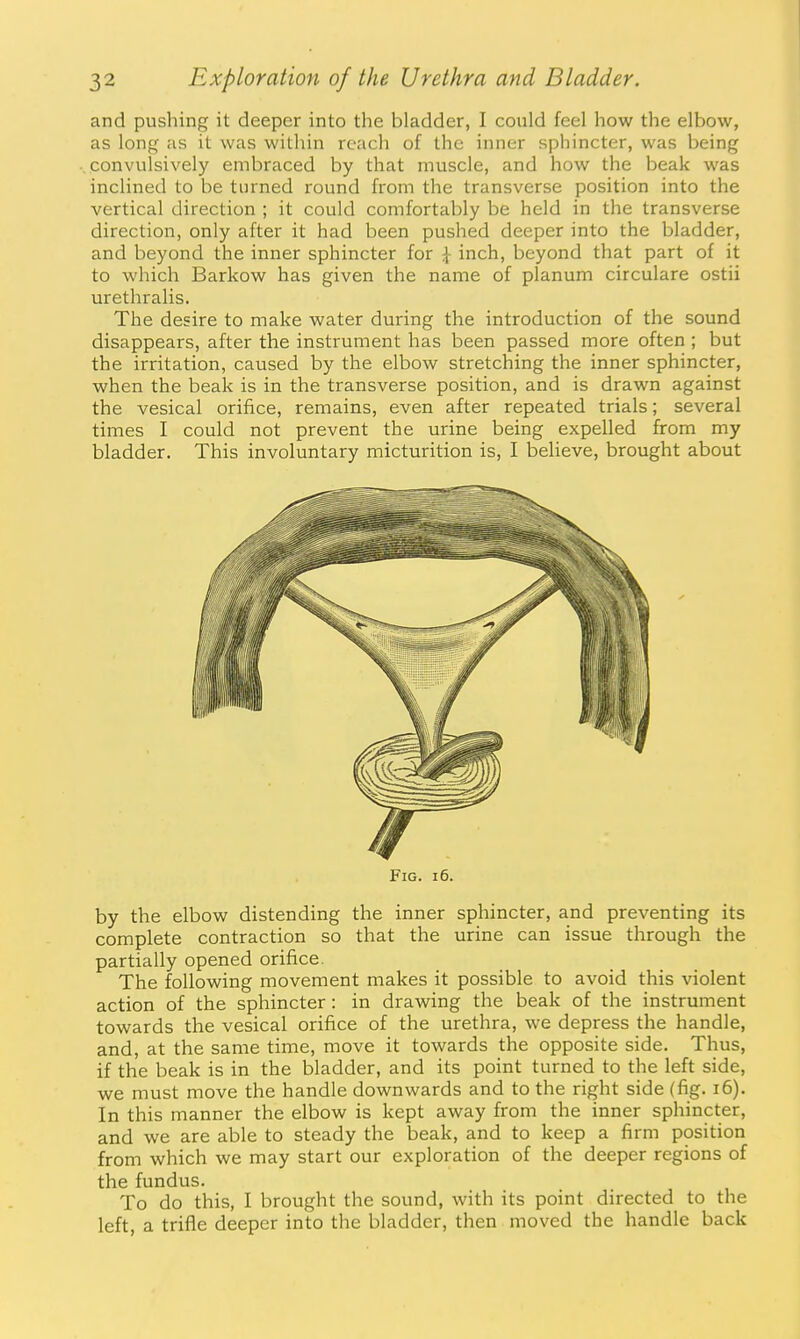 and pushing it deeper into the bladder, I could feel how the elbow, as long ;vs it was within reach of the inner sphincter, was being convulsively embraced by that muscle, and how the beak was inclined to be turned round from the transverse position into the vertical direction ; it could comfortably be held in the transverse direction, only after it had been pushed deeper into the bladder, and beyond the inner sphincter for \ inch, beyond that part of it to which Barkow has given the name of planum circulare ostii urethralis. The desire to make water during the introduction of the sound disappears, after the instrument has been passed more often ; but the irritation, caused by the elbow stretching the inner sphincter, when the beak is in the transverse position, and is drawn against the vesical orifice, remains, even after repeated trials; several times I could not prevent the urine being expelled from my bladder. This involuntary micturition is, I believe, brought about Fig. i6. by the elbow distending the inner sphincter, and preventing its complete contraction so that the urine can issue through the partially opened orifice. The following movement makes it possible to avoid this violent action of the sphincter: in drawing the beak of the instrument towards the vesical orifice of the urethra, we depress the handle, and, at the same time, move it towards the opposite side. Thus, if the beak is in the bladder, and its point turned to the left side, we must move the handle downwards and to the right side (fig. i6). In this manner the elbow is kept away from the inner sphincter, and we are able to steady the beak, and to keep a firm position from which we may start our exploration of the deeper regions of the fundus. To do this, I brought the sound, with its point directed to the left, a trifle deeper into the bladder, then moved the handle back