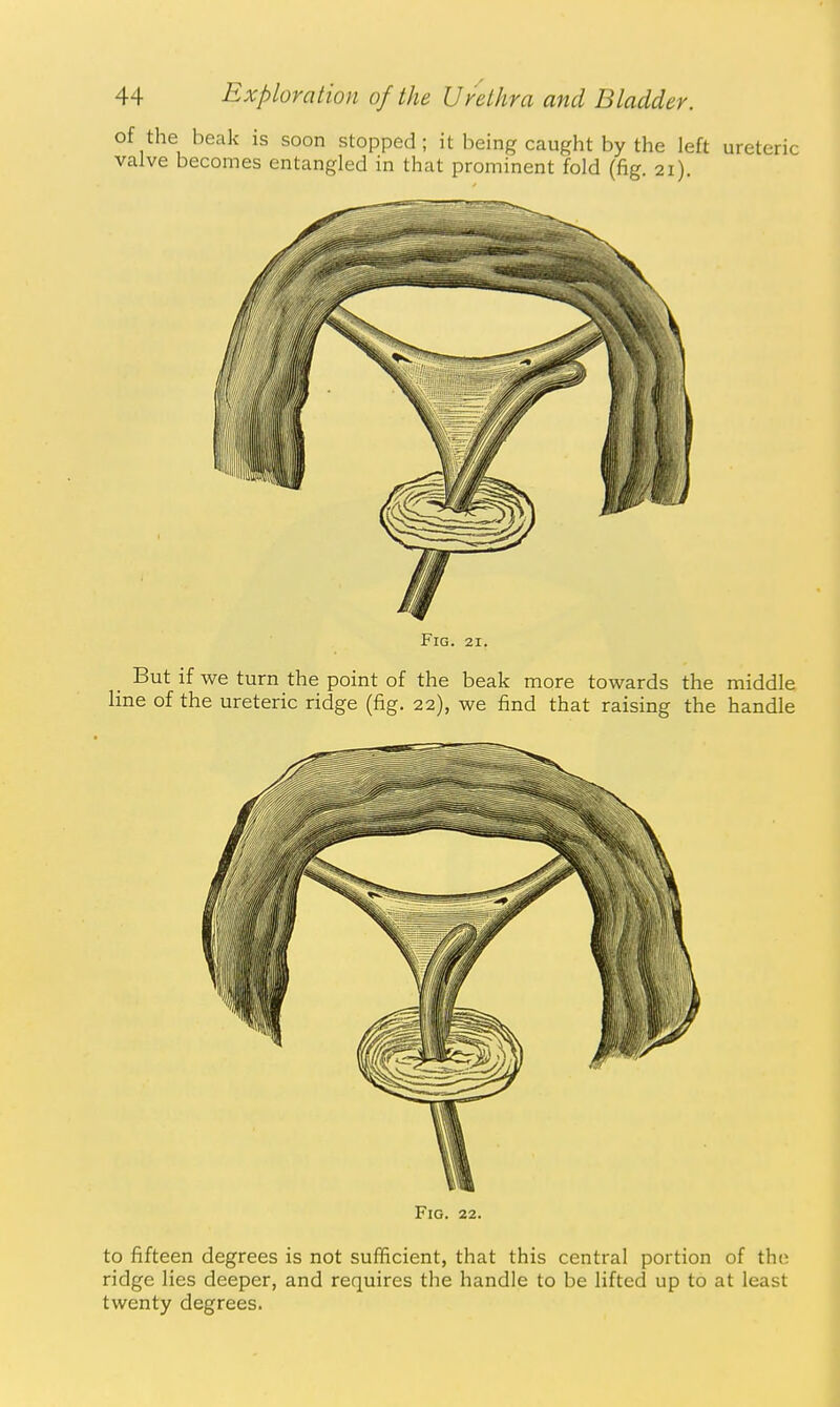 of the beak is soon stopped; it being caught by the left ureteric valve becomes entangled in that prominent fold (fig. 21). Fig. 21. _ But if we turn the point of the beak more towards the middle line of the ureteric ridge (fig. 22), we find that raising the handle Fig. 22. to fifteen degrees is not sufficient, that this central portion of the ridge lies deeper, and requires the handle to be lifted up to at least twenty degrees.
