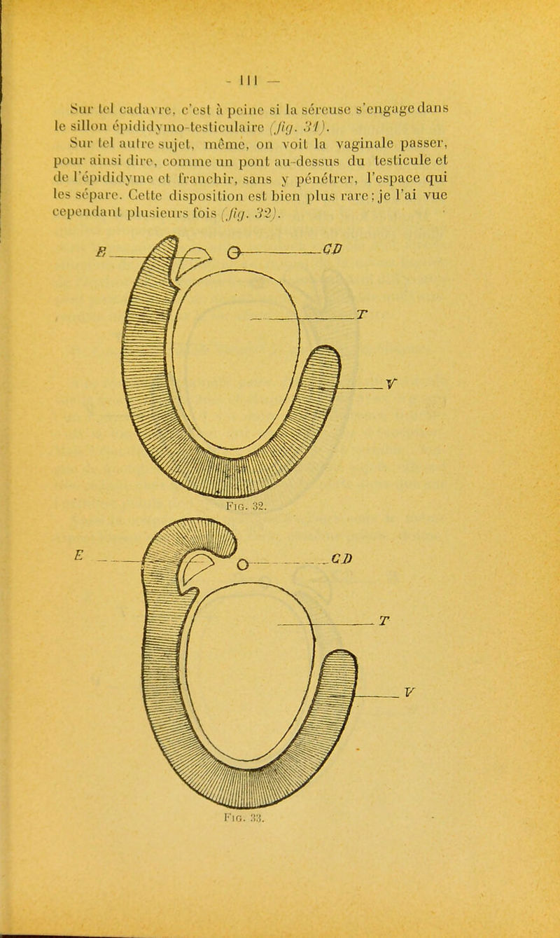 Sur U'I cuciuM'c. c'est à peine si la séreuse s'engage dans le sillon épididYnio-tcsticulaire (Juj. Sur tel autre sujet, même, on voit la vaginale passer, pour ainsi dire, comme un pont au-dessus du lesticule et de l'épididynie et franchir, sans y pénétrer, l'espace qui les sépare. Cette disposition est bien plus rare; je l'ai vue cependant plusieurs fois (Jicj. 3-2).