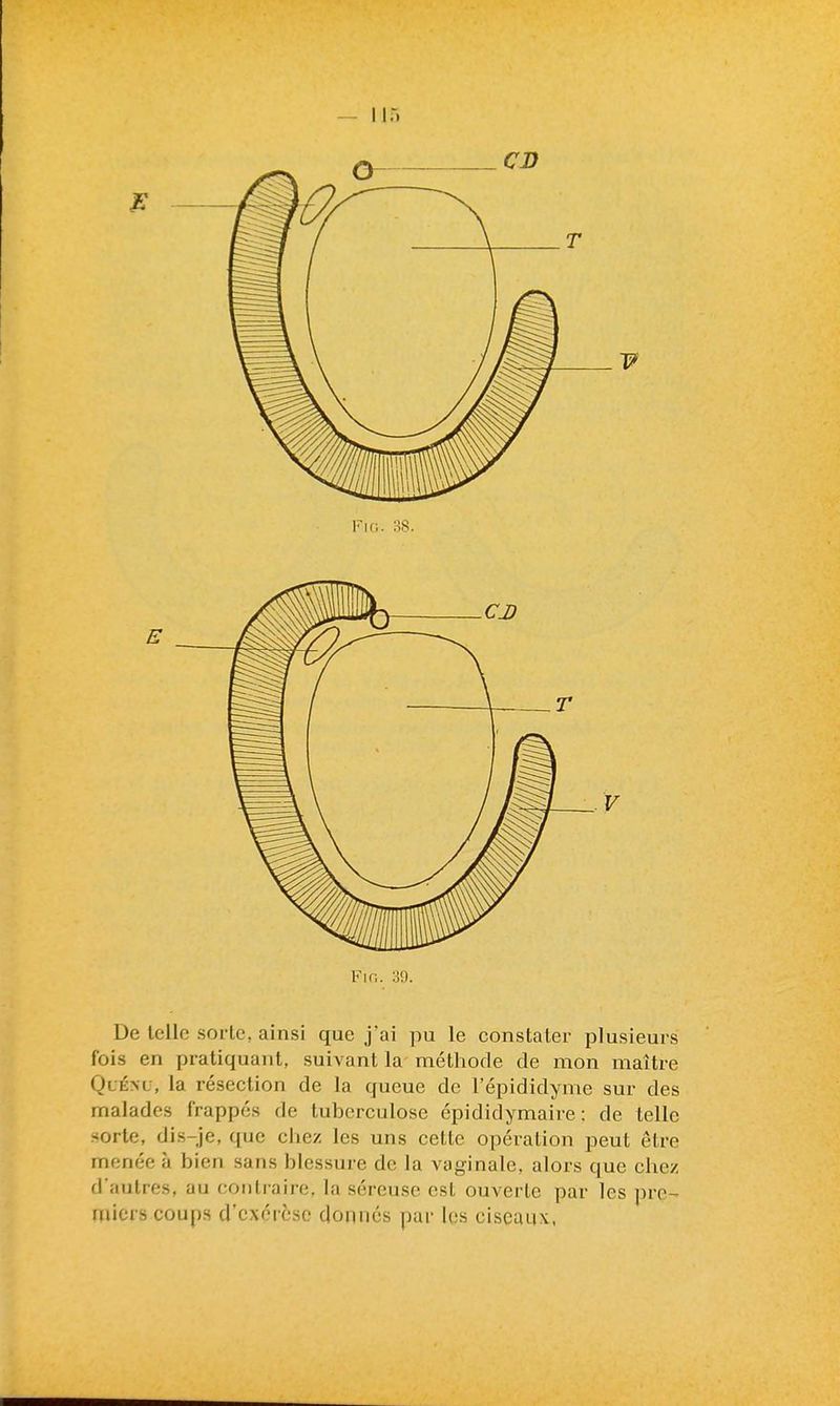 De telle sorte, ainsi que j'ai pu le constater plusieurs fois en pratiquant, suivant la méthode de mon maître QuÉNL-, la résection de la queue de l'épididyme sur des malades frappés de tuberculose épididymaire : de telle sorte, dis-je, que chez les uns cette opération peut être menée à bien sans blessure de la vaginale, alors que chez d'autres, au contraire, la séreuse est ouverte par les pre- miers coups d'exérèse donnés par les ciscau\,