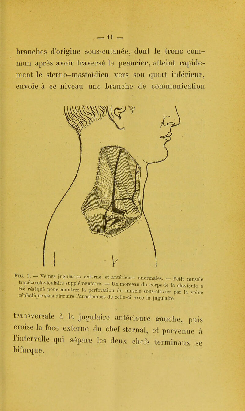 branches d'origine sous-cutanée, dont le tronc com- mun après avoir traversé le peaucier, atteint rapide- ment le sterno-mastoïdien vers son quart inférieur, envoie à ce niveau une branche de communication Fig. 1. — Veines jugulaires externe et antérieure anormales. — Petit muscle trapézo-claviculaire supplémentaire. — Un morceau du corps de la clavicule a été réséqué pour montrer la perforation du muscle sous-clavier par la veine céphalique sans détruire l'anastomose de celle-ci avec la jugulaire transversale à la jugulaire antérieure gauche, puis croise la face externe du chef sternal, et parvenue à l'intervalle qui sépare les deux chefs terminaux se bifurque.