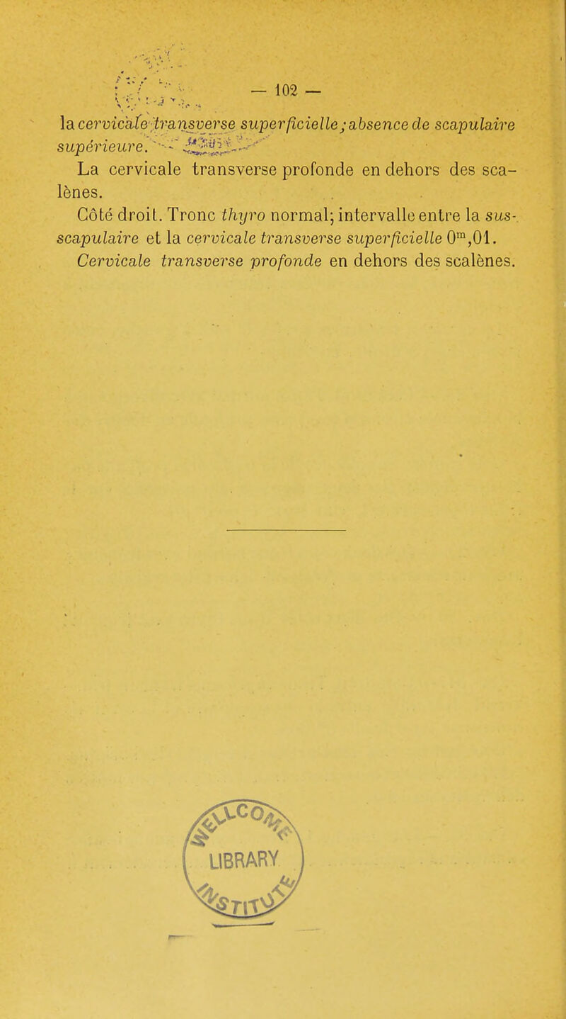 la cervicale 'transverse superficielle;absence de scapulaire supérieure. ££?JJ.---''' La cervicale transverse profonde en dehors des sca- lènes. Côté droit. Tronc thyro normal; intervalle entre la sus- scapulaire et la cervicale transverse superficielle 0m,01. Cervicale transverse profonde en dehors des scalènes.