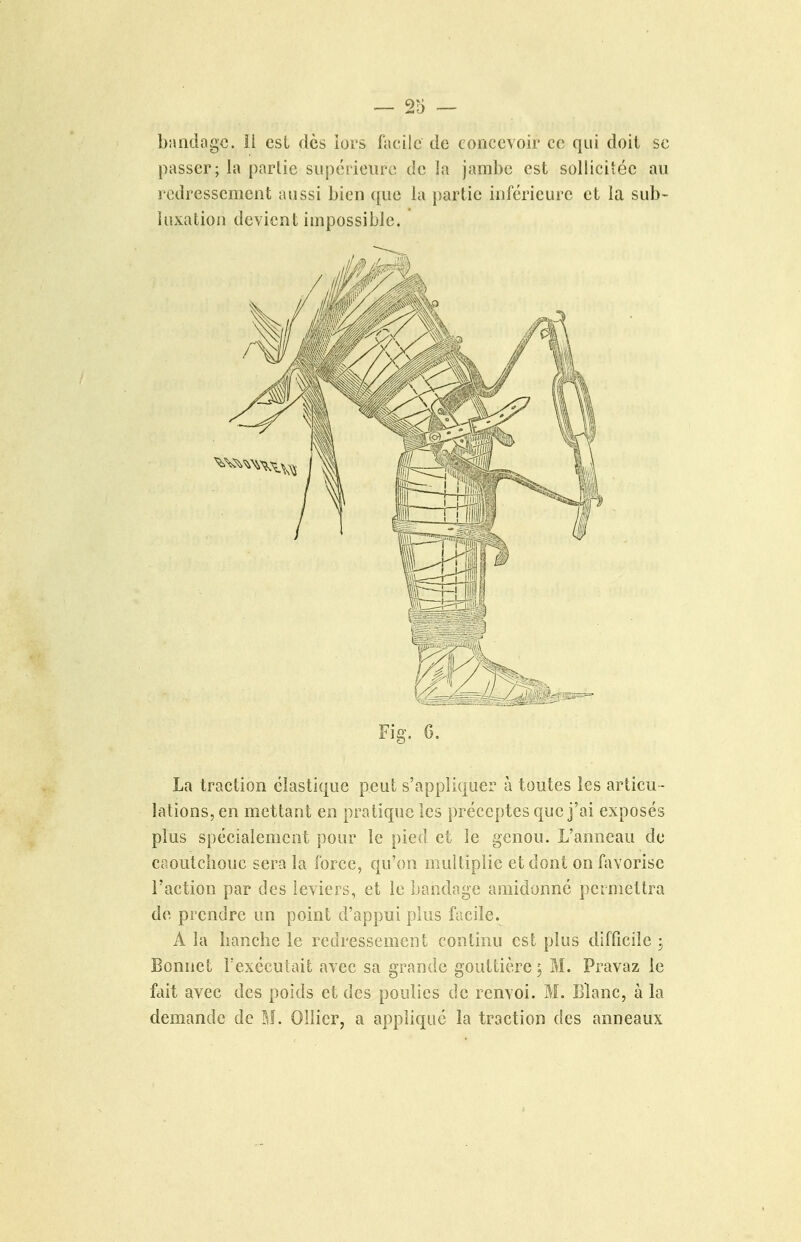 blindage. ïl csL dès iors facile de concevoir ce qui doit se passer; la parlie siipéiieiire de la jambe est sollicitée au redressement aussi bien que la partie inférieure et la sub- luxatioii devient impossible. Fig. 6. La traction élastique peut s'appliquer à toutes les articu - lations, en mettant en pratique les préceptes que j'ai exposés plus spécialement pour le pied et le genou. L'anneau de caoutchouc sera la force, qu'on multiplie et dont on favorise l'action par des leviers, et le ])andagc amidonné permettra de prendre un point d'appui plus facile. A la banclîe le redressement continu est plus difficile , Bonnet i'exécuhiit avec sa grande gouttière 5 M. Pravaz ie fait avec des poids et des poulies de renvoi. M. Blanc, à la demande de M. Ollicr, a appliqué la traction des anneaux