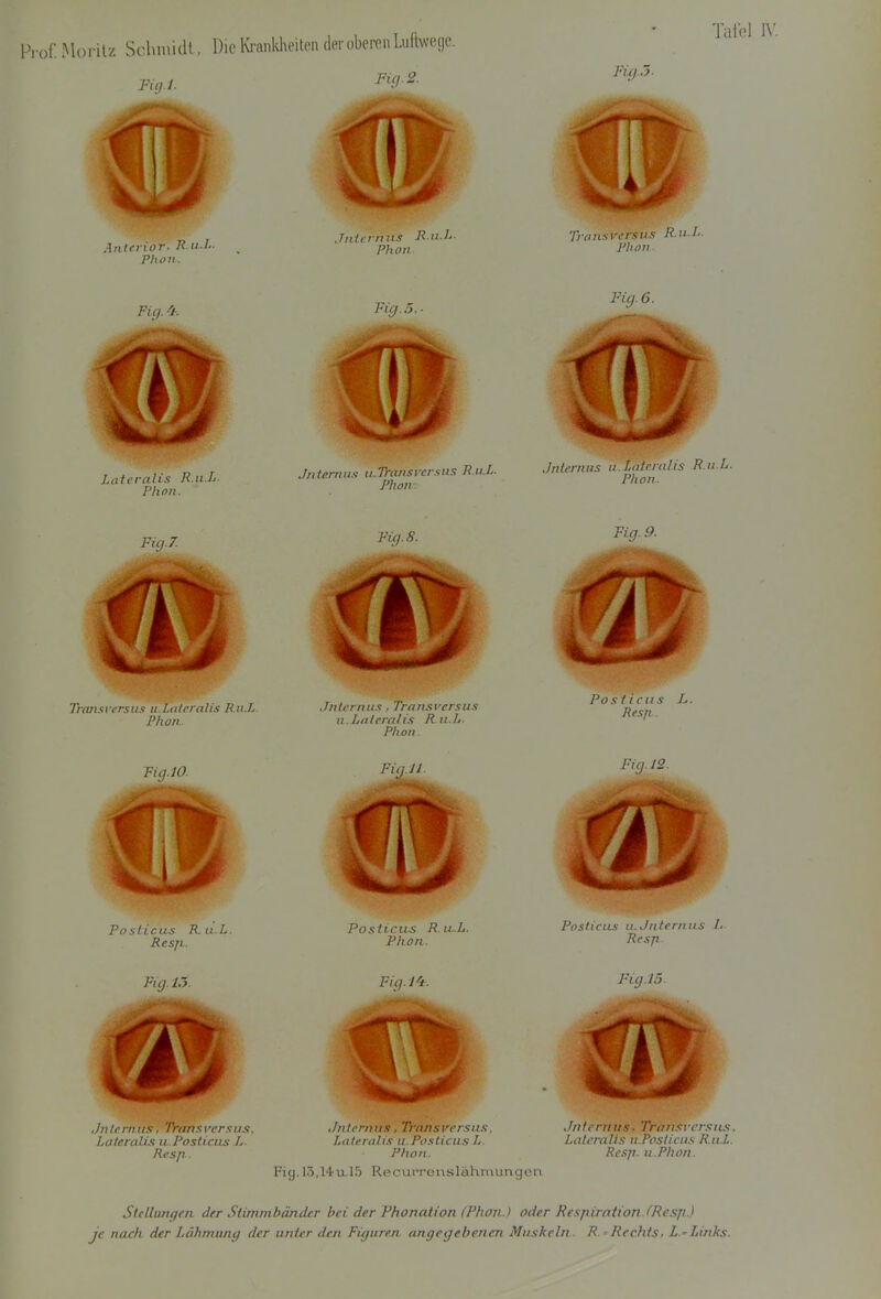 Prof: Morilz Schiuidl, Die iMcuikhcilen (1er oberen Luftwege. Fig. 2. Fin I Anterior, R.u.l.. Phon. Jniirnus R.u.L. Phon. Ta FÜJ.5. Transversu.'i R.u.l.. Rh Oll Lateralis R.u.L. Phon. Fig.5.- Jnternu.i u.Ti-ansycr.-itis R.u.L. Phou. Fig. 6. Jnlt'niiis it.LdIcntlis R.u.L. Phon. Fig.7. Fig. 8. Fig. 9. Traiisversus u.Lateralis R.u.L. Phon. Jnteriiu.'!, Trarisversus n.Lalerahs R.u.L. Phon. Posliciis L. Resjx Fig.lO. i-'i.j 11 Fig. 12. Poslicus R ii.L. Pos Ileus R.u,.L. Phon. Posluu.'i II J/iternus L. Resp ■ Fig. L->. Fig.lO. Fig.15. Jnii rnu.^. 'rrnii.wcrsus. .Internus, Tronsversus. Jnferntis, Tritnsrersius LaleraUs u.Posticus L. Lateralis u.PosLicus L. Lateralis u.Posticus R.u.L. Resp.. Phon. Resp. u.Phon. Fig.l3,Hu.l5 Recuvrenslähmungen Stellungen, der Stimmbänder hei der Phonation (Phon.) oder Respiration, fResp.) je nach der Lähmung der unier den Figuren, angegebenen Muskeln . R. - Rechts. Z - Links.