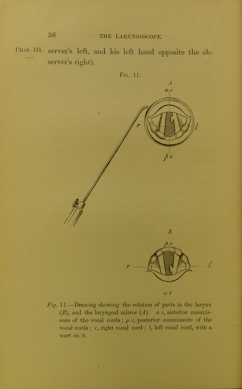 Chap. nr. server's left, and his left hand opposite the ob- server's right). Fig. 11. A a c B /> c r / c'c Fiy. 11.—Drawing showing the relation of parts in the larynx (£), and the laryngeal mirror (A), a c, anterior commis- sure of the vocal cords; p c, posterior commissure of the vocal cords ; r, right vocal cord ; /, left vocal cord, with a wart on it.