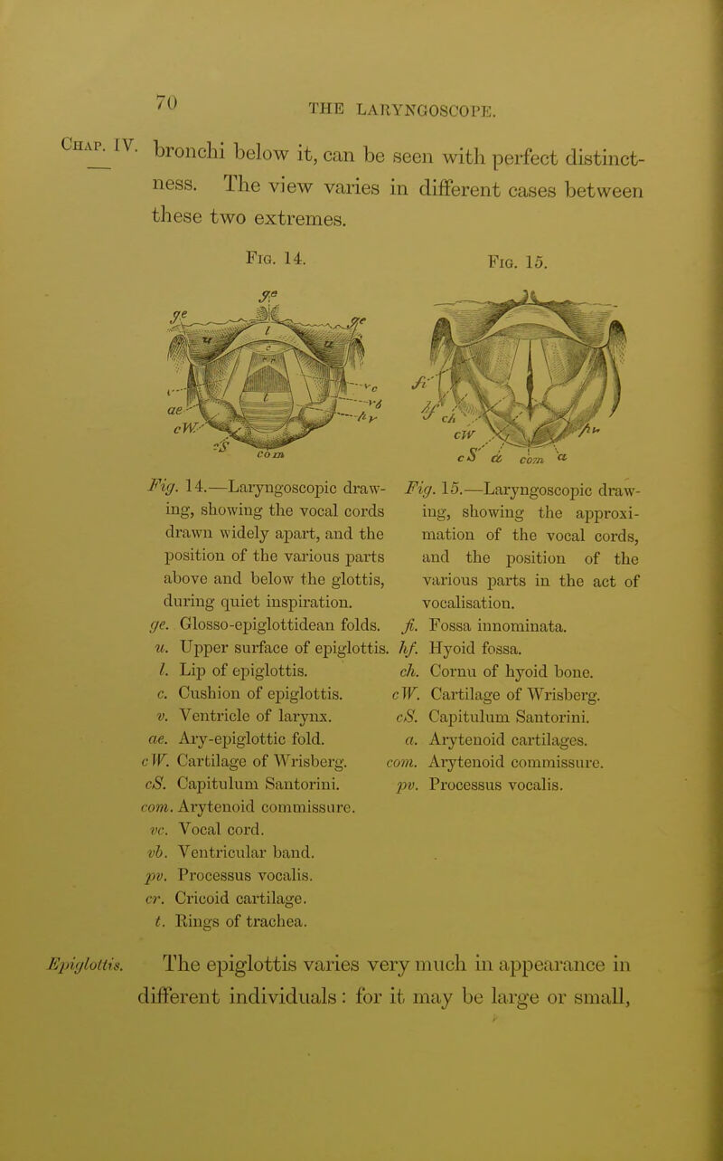 THE LARYNGOSCOPE. Chap^iv. -bronchi below it, can be seen with perfect distinct- ness. The view varies in different cases between these two extremes. Fig. H. Fig. 15. ti< com a Fig. 14.—Laryngoscopy draw- ing, showing the vocal cords drawn widely apart, and the position of the various parts above and below the glottis, during quiet inspiration. ge. Glosso-epiglottidean folds. u. Upper surface of epiglottis, hf. Hyoid fossa. Fig. 15.—Laryngoscopy draw- ing, showing the approxi- mation of the vocal cords, and the position of the various parts in the act of vocalisation. fi. Fossa innominata. ch. Cornu of hyoid bone. cW. Cartilage of Wrisberg. cS. Capitulum Santorini. a. Arytenoid cartilages. com. Arytenoid commissure. pv. Processus vocalis. /. Lip of epiglottis. c. Cushion of epiglottis. v. Ventricle of larynx. ae. Ary-epiglottic fold. cW. Cartilage of Wrisberg. cS. Capitulum Santorini. com. Arytenoid commissure. vc. Vocal cord. vb. Ventricular band. pv. Processus vocalis. <•/•. Cricoid cartilage. t. Rings of trachea. Epiglottis. The epiglottis varies very much in appearance in different individuals: for it may be large or small,