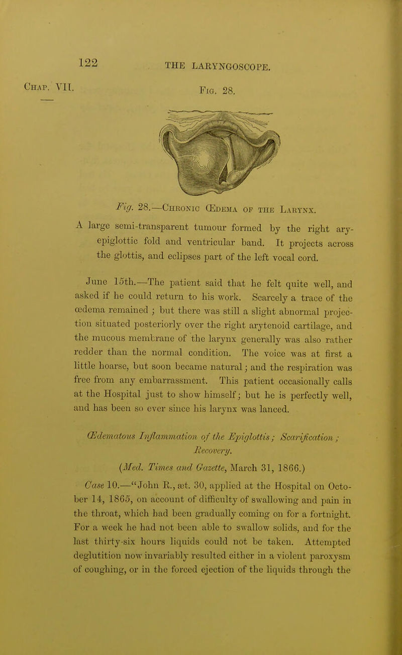Chap. VII. THE LARYNGOSCOPE. Fio. 28. Fig. 28.—Chronic (Edema op the Larynx. A large semi-transparent tumour formed by the right ary- epiglottic fold and ventricular band. It projects across the glottis, and eclipses part of the left vocal cord. June loth.—The patient said that he felt quite well, and asked if he could return to his work. Scarcely a trace of the oedema remained ; but there was still a slight abnormal projec- tion situated posteriorly over the right arytenoid cartilage, and the mucous membrane of the larynx generally was also rather redder than the normal condition. The voice was at first a little hoarse, but soon became natural; and the respiration whs free from any embarrassment. This patient occasionally calls at the Hospital just to show himself; but he is perfectly well, and has been so ever since his larynx was lanced. (Edematous Inflammation of the Epiglottis ; Scarification ; Recovery. (Med. Times and Gazette, March 31, 1866.) ('ase 10.—John R., aet, 30, applied at the Hospital on Octo- ber 14, 1865, on account of difficulty of swallowing and pain in the throat, which had been gradually coming on for a fortnight. For a week he had not been able to swallow solids, and for the last thirty-six hours liquids could not be taken. Attempted deglutition now invariably resulted either in a violent paroxysm of coughing, or in the forced ejection of the liquids through the