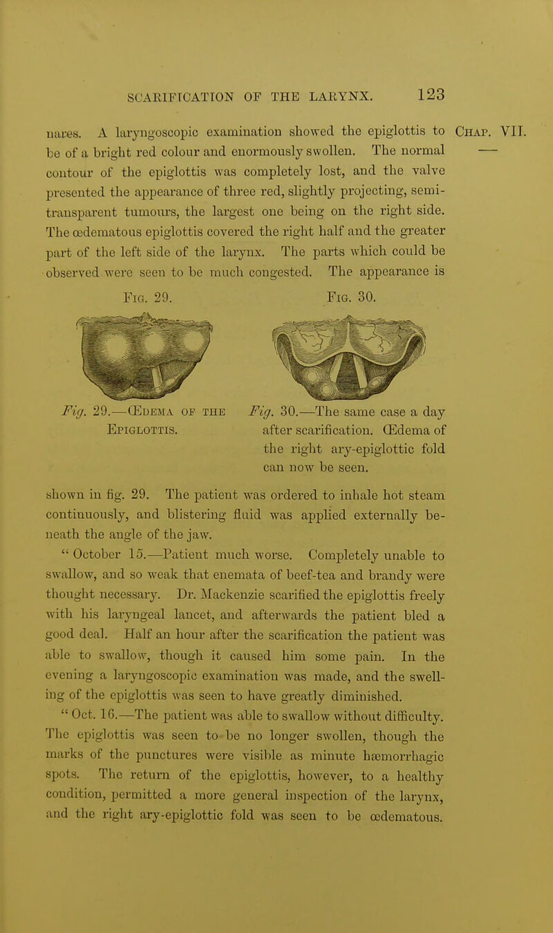 napes. A laryngoscopic examination showed the epiglottis to Chat. VII. be of a bright red colour and enormously swollen. The normal — contour of the epiglottis was completely lost, and the valve presented the appearance of three red, slightly projecting, semi- transparent tumours, the largest one being on the right side. The (edematous epiglottis covered the right half and the greater part of the left side of the larynx. The parts which could be observed were seen to be much congested. The appearance is Fig. 29. Fig. 30. Fig. 29.—(Edema of the Fig. 30.—The same case a day Epiglottis. after scarification. (Edema of the right ary-epiglottic fold can now be seen. shown in fig. 29. The patient was ordered to inhale hot steam continuously, and blistering fluid was applied externally be- neath the angle of the jaw.  October 15.—Patient much worse. Completely unable to swallow, and so weak that enemata of beef-tea and brandy were thought necessary. Dr. Mackenzie scarified the epiglottis freely with his laryngeal lancet, and afterwards the patient bled a good deal. Half an hour after the scarification the patient was able to swallow, though it caused him some pain. In the evening a laryngoscopy examination was made, and the swell- ing of the epiglottis was seen to have greatly diminished.  Oct. 16.—The patient was able to swallow without difficulty. The epiglottis was seen to be no longer swollen, though the marks of the punctures were visible as minute hsemorrhagic spots. The return of the epiglottis, however, to a healthy condition, permitted a more general inspection of the larynx, and the right ary-epiglottic fold was seen to be codematous.