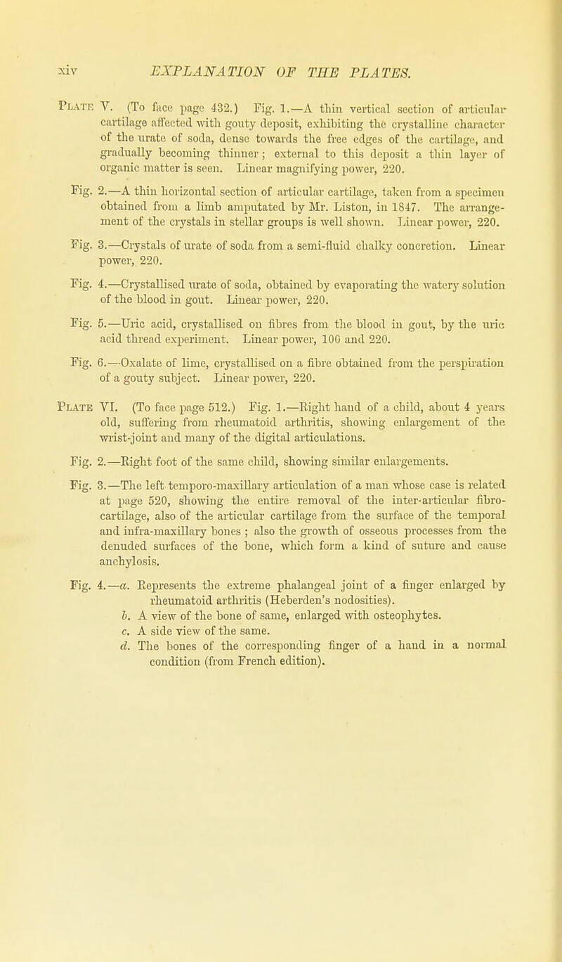 Plate V. (To fuce page 432.) Fig. 1.—A tliin vertical section of articnlai- cartilage affected mtli gouty deposit, exhibiting the cry.stalline charactcii- of the lU'ato of soda, dense towards the free edges of the cartilage, and gradually becoming thinner; external to this deposit a tliin layer of organic matter is seen. Linear magnifying power, 220. Fig. 2.—A. thin horizontal section of articular cartilage, taken from a specimen obtained from a limb amputated by Mr. Listen, in 1847. The arrange- ment of the crystals in stellar groups is well shown. Linear power, 220. Fig. 3.—Crystals of urate of soda from a semi-fluid chalky concretion. Linear power, 220. rig. 4.—Crystallised nrate of soda, obtained by evaporatmg the watery solution of the blood in gout. Linear- power, 220. Kg. 5.—Uric acid, crystallised ou fibres from the blood in gout, by the urie acid thread experiment. Linear power, 100 and 220. Fig. 6.—Oxalate of lime, crystallised on a fibre obtained from the perspii-ation of a gouty subject. Linear power, 220. Plate VI. (To face page 512.) Fig. 1.—Eight hand of a child, about 4 years old, suffering from rheumatoid arthritis, showing enlargement of the wiist-joint and many of the digital articulations. Fig. 2.—Eight foot of the same cliild, showing similar enlargements. Fig. 3.—The left temporo-maxillary articulation of a man whose case is related at iJage 520, showing the entire removal of the inter-articirlar fibro- cartilage, also of the articular cartilage from the surface of the temporal and infra-maxiUary bones ; also the growth of osseous processes from the denuded surfaces of the bone, which form a kind of sutiu'e and cause anchylosis. Fig. 4.—a. Eepresents the exti-eme phalangeal joint of a finger enlarged by rheumatoid arthritis (Heberden's nodosities). h. A view of the bone of same, enlarged with osteoiihytes. c. A side view of the same. d. The bones of the corresponding finger of a hand in a normal condition (from French edition).