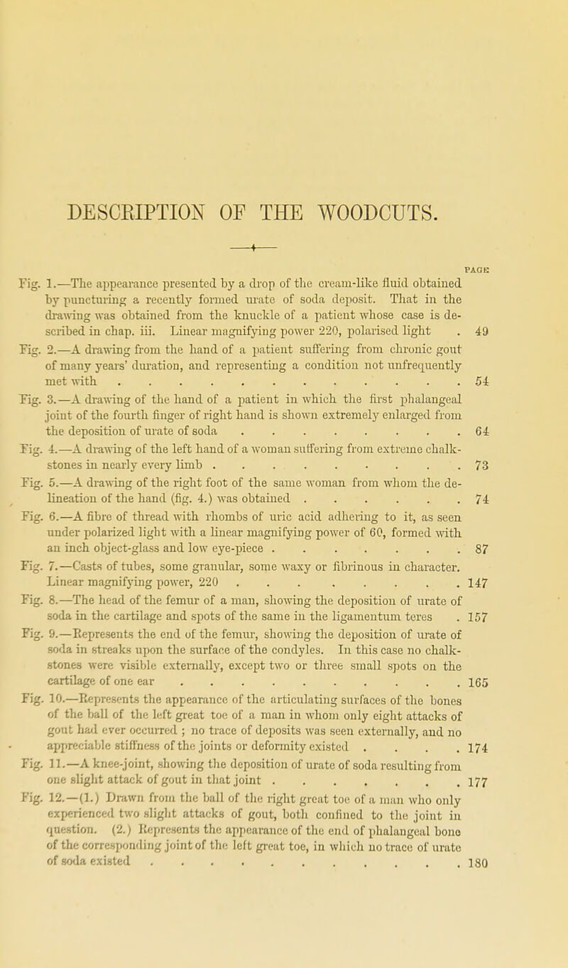 DESCRIPTION OF THE WOODCUTS. —♦— PAGE Fig. 1.—The appearance presented by a drop of the cream-like fluid obtained by puncturing a recently formed mate of soda deposit. Tliat in the di-awing was obtained from the knuckle of a patient whose case is de- scribed in chap. iii. Linear magnifying power 220, polarised light . 49 Fig. 2.—A drawing fi-om the hand of a patient suffering from chronic gout of many years' dm-ation, and representing a condition not unfrequently met with ............ Si Fig. 3.—A di-awing of the hand of a patient in which the first phalangeal joint of the fourth finger of right hand is shown extremely enlarged from the deposition of urate of soda . . . . . . , . 6i Fig. 4.—A di-awing of the left hand of a woman suffering from extreme chalk- stones in nearly every limb . . . . . . . . .73 Fig. 5.—A dra^\'ing of the right foot of the same woman from whom the de- lineation of the hand (fig. 4.) was obtained . . . . . .74 Fig. 6.—A fibre of thread with rhombs of uric acid adheiiug to it, as seen under polarized light with a linear magnifying power of 60, formed ^vith an inch object-glass and low eye-piece ....... 87 Fig. 7.—Casts of tubes, some granular, some waxy or fibrinous in character. Linear magnifying power, 220 ... ..... 147 Fig. 8.—The head of the femur of a man, showing the deposition of urate of soda in the cartilage and spots of the same in the ligamentum teres . 157 Fig. 9.—Represents the end of the femur, showing the deposition of urate of soda in streaks upon the surface of the condyles. In this case no chalk- stones were visible e.xtemally, except two or three small spots on the cartilage of one ear . 165 Fig. 10.—Represents the appearance of the articulating surfaces of the bones of the ball of the left great toe of a man in whom only eight attacks of gout liail ever occurred ; no trace of deposits was seen externally, and no appreciable stiffness of the joints or deformity existed .... 174 Fig. 11.—A knee-joint, showing tlie deposition of urate of soda resulting from one slight attack of gout in that joint 177 Fig. 12.—(1.) Drawn from the ball of tlie right great toe of a man who only experienced two sliglit attacks of gout, botli confined to the joint in question. (2.) Kepre.sents the apjiearance of the end of phalangeal bono of the corresponding joint of the left gi'eat toe, in which no trace of urate of soda existed 180