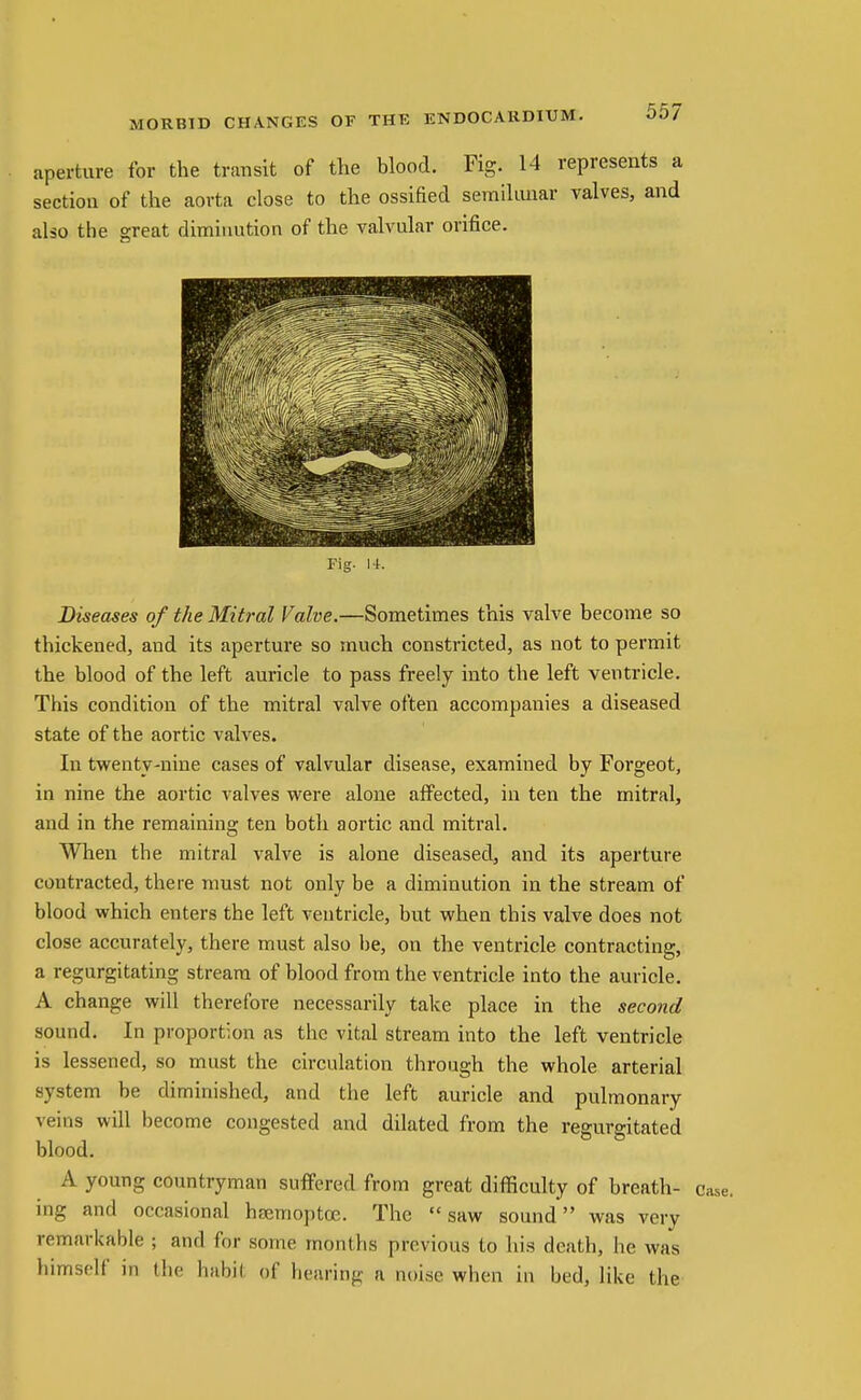 aperture for the transit of the blood. Fig. 14 represents a section of the aorta close to the ossified semilunar valves, and also the great diminution of the valvular orifice. Fig. I K Diseases of the Mitral Valve.—Sometimes this valve become so thickened, and its aperture so much constricted, as not to permit the blood of the left auricle to pass freely into the left ventricle. This condition of the mitral valve often accompanies a diseased state of the aortic valves. In twenty-nine cases of valvular disease, examined by Forgeot, in nine the aortic valves were alone affected, in ten the mitral, and in the remaining ten both aortic and mitral. When the mitral valve is alone diseased, and its aperture contracted, there must not only be a diminution in the stream of blood which enters the left ventricle, but when this valve does not close accurately, there must also l)e, on the ventricle contracting, a regurgitating stream of blood from the ventricle into the auricle. A change will therefore necessarily take place in the second sound. In proportion as the vital stream into the left ventricle is lessened, so must the circulation through the whole arterial system be diminished, and the left auricle and pulmonary veins will become congested and dilated from the regurgitated blood. A young countryman suffered from great difficulty of breath- case, ing and occasional hremoptce. The saw sound was very remarkable ; and for some months previous to his death, he was himself in the habit of hearing a noise when in bed, like the