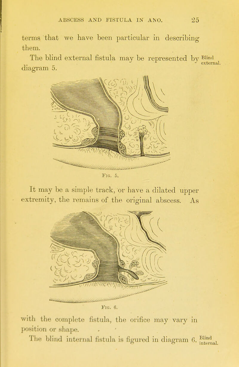 terms that we have been particular in describing them. The bhnd external fistula may be represented by ^ii°<J external. diagram 5. It may be a simple track, or have a dilated upper extremity, the remains of the original abscess. As Fig. 6. vvith the complete fistula, the orifice may vary in position or shape. The blind internal fistula is figured in diam-am G. ^l'* , O o internal.