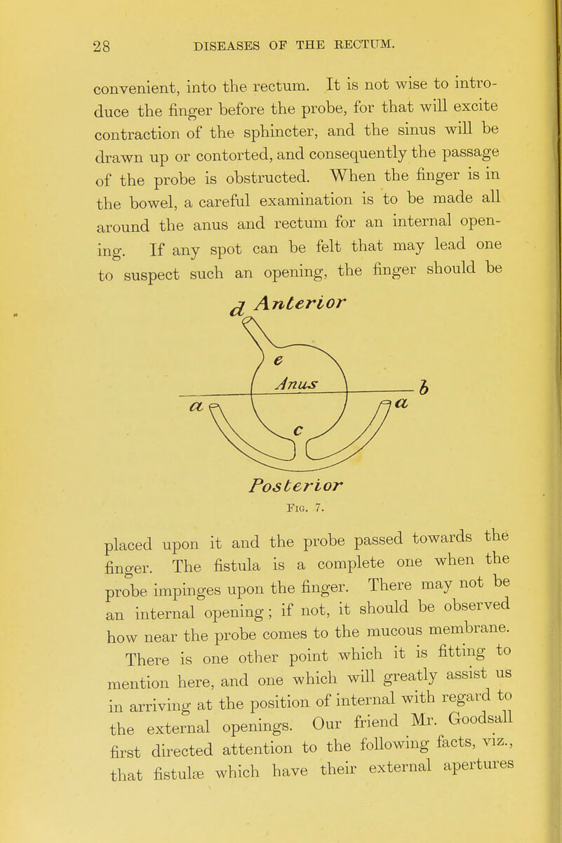 convenient, into the rectum. It is not wise to intro- duce the finger before the probe, for that will excite contraction of the sphincter, and the sinus will be drawn up or contorted, and consequently the passage of the probe is obstructed. When the finger is in the bowel, a careful examination is to be made all around the anus and rectum for an internal open- ing. If any spot can be felt that may lead one to suspect such an opening, the finger should be ^ Anterior Posterior Fig. 7. placed upon it and the probe passed towards the finger. The fistula is a complete one when the probe impinges upon the finger. There may not be an internal opening; if not, it should be observed how near the probe comes to the mucous membrane. There is one other point which it is fitting to mention here, and one which will greatly assist us in arriving at the position of internal with regard to the external openings. Our friend Mr. Goodsall first directed attention to the followmg facts, viz., that fistuk^ which have their external apertures