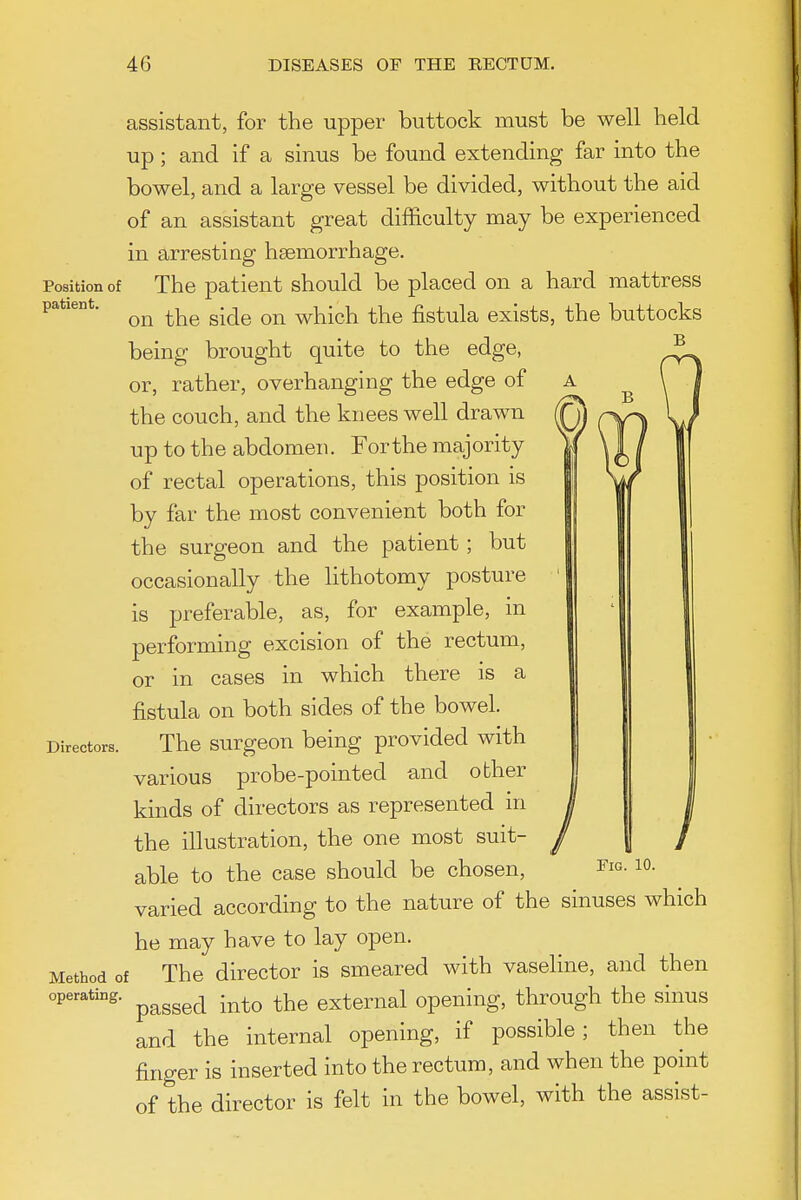 Position of patient. assistant, for the upper buttock must be well held up; and if a sinus be found extending far into the bowel, and a large vessel be divided, without the aid of an assistant great difficulty may be experienced in arresting haemorrhage. The patient should be placed on a hard mattress on the side on which the fistula exists, the buttocks being brought quite to the edge, or, rather, overhanging the edge of the couch, and the knees well drawn up to the abdomen. For the majority of rectal operations, this position is by far the most convenient both for the surgeon and the patient ; but occasionally the lithotomy posture is preferable, as, for example, in performing excision of the rectum, or in cases in which there is a fistula on both sides of the bowel. Directors. The surgeou being provided with various probe-pointed and other kinds of directors as represented in the illustration, the one most suit- able to the case should be chosen, varied according to the nature of the sinuses which he may have to lay open. Method of The director is smeared with vaseline, and then operating. ^^^^^^ .^^^ ^-^^ external opening, through the sinus and the internal opening, if possible; then the finger is inserted into the rectum, and when the point of the director is felt in the bowel, with the assist- FiG. 10.