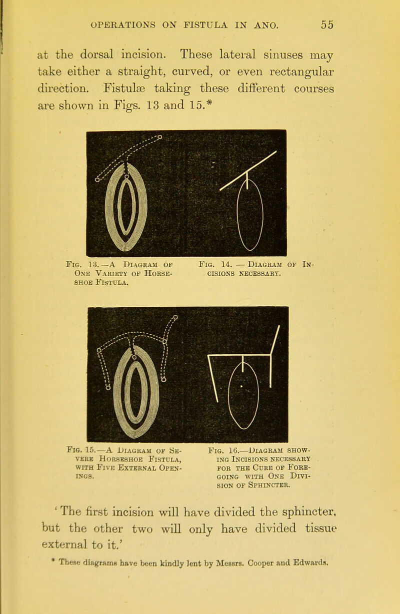 at the dorsal incision. These lateral sinuses may take either a straight, curved, or even rectangular direction. Fistulse taking these different courses are shown in Figs. 13 and 15.* Fig. 13.—A DiAGKAJi of Fig. 14.—Diagram of In- One Vabiety of Horse- oisions keckssart. SHOE Fistula. Fig. 15.—A Jjiagkam of Se- vere HoasESHOE Fistula, with Five External Open- ings. Fig. 16.—Diagram show- ing Incisions necessary FOR THE Cure of Fore- going WITH One Divi- sion OF Sphincter. ' The first incision will have divided the sphincter, but the other two will only have divided tissue external to it.' * These diagrama have been kindly lent by Messrs. Cooper and Edwards.