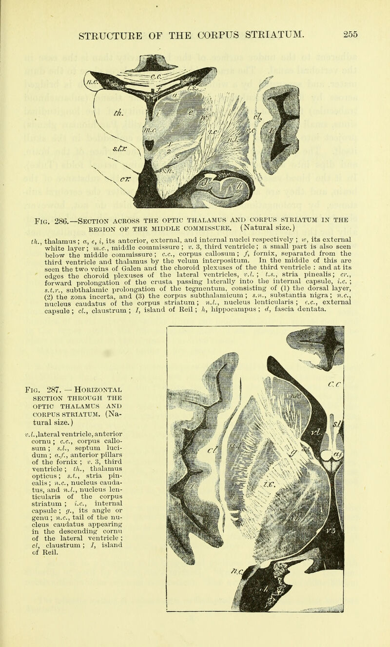 Fig. 286.—Section across the optic thalamus and corpus striatum in the REGION OF THE MIDDLE COMMISSURE. (Natural size.) th. thalamus ; a, e, i, its anterior, external, and internal nuclei respectively ; w, its external ' white layer; m.c, middle commissure; v. 3, third ventricle; a small part is also seen below the middle commissure; c.c, corpus callosum; /, fornix, separated from the third ventricle and thalamus by the velum interpositum. In the middle of this are seen the two veins of Galen and the choroid plexuses of the third ventricle : and at its ' edges the choroid plexuses of the lateral ventricles, v.L; t.s., stria pinealis; cr., forward prolongation of the crusta passing laterally into the internal capsule, i.e. ; s.t.r., subthalamic prolongation of the tegmentum, consisting of (1) the dorsal layer, (2) the zona incerta, and (3) the corpus subthalamicum ; s.n., substantia nigra; n.c, nucleus caudatus of the corpus striatum; n.L, nucleus lenticularis ; e.c, external capsule ; cL, claustrum ; /, island of Reil; li, hippocampus ; d, fascia dentata. Fig. 287. — Horizontal section through the optic thalamus and CORPUS STRIATUM. (Na- tural size.) V. I. ,lateral ventricle, anterior cornu; c.c, corpus callo- sum ; S.I., septum luci- dum ; a,/., anterior pillars of the fornix ; v. 3, third ventricle; th., thalamus opticus; s.t., stria pin- ealis; n.c, nucleus cauda- tus, and n.L, nucleus len- ticularis of the corpus striatum ; i.e., internal capsule; g., its angle or genu ; n.c., tail of the nu- cleus caudatus appeai-ing in the descending cornu of the lateral ventricle ; cl, claustrum; /, island of Reil. I*