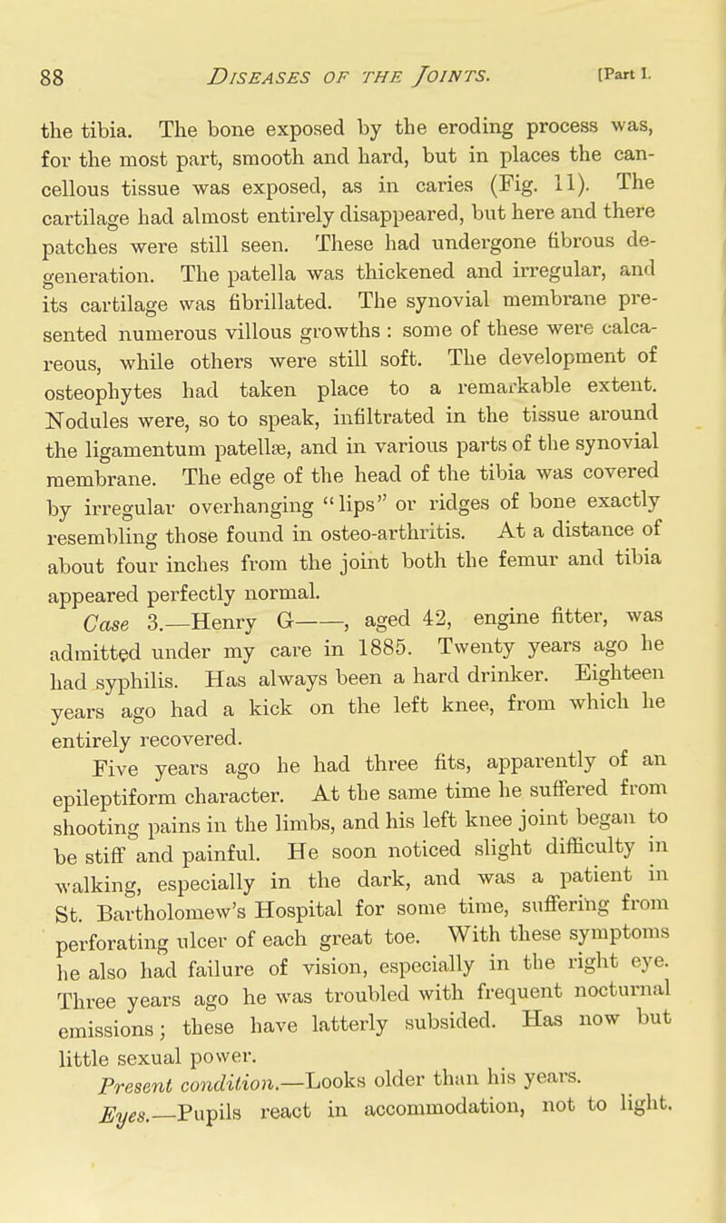 the tibia. The bone exposed by the eroding process was, for the most part, smooth and hard, but in places the can- cellous tissue was exposed, as in caries (Fig. 11). The cartilage had almost entirely disappeared, but here and there patches were still seen. These had undergone fibrous de- generation. The patella was thickened and irregular, and its cartilage was fibrillated. The synovial membrane pre- sented numerous villous growths : some of these were calca- reous, while others were still soft. The development of osteophytes had taken place to a remarkable extent. Nodules were, so to speak, infiltrated in the tissue around the ligamentum patellse, and in various parts of the synovial membrane. The edge of the head of the tibia was covered by irregular overhanging lips or ridges of bone exactly resembling those found in osteo-arthritis. At a distance of about four inches from the joint both the femur and tibia appeared perfectly normal. Case 3.—Henry G , aged 42, engine fitter, was admitted under my care in 1885. Twenty years ago he had syphilis. Has always been a hard drinker. Eighteen years ago had a kick on the left knee, from which he entirely recovered. Five years ago he had three fits, apparently of an epileptiform character. At the same time he suffered from shooting pains in the limbs, and his left knee joint began to be stiff and painful. He soon noticed slight difficulty in walking, especially in the dark, and was a patient in St. Bartholomew's Hospital for some time, suffering from perforating ulcer of each great toe. With these symptoms he also had failure of vision, especially in the right eye. Three years ago he was troubled with frequent nocturnal emissions; these have latterly subsided. Has now but little sexual power. Present condition.—Looksi older than his years. —Pupils react in accommodation, not to light.