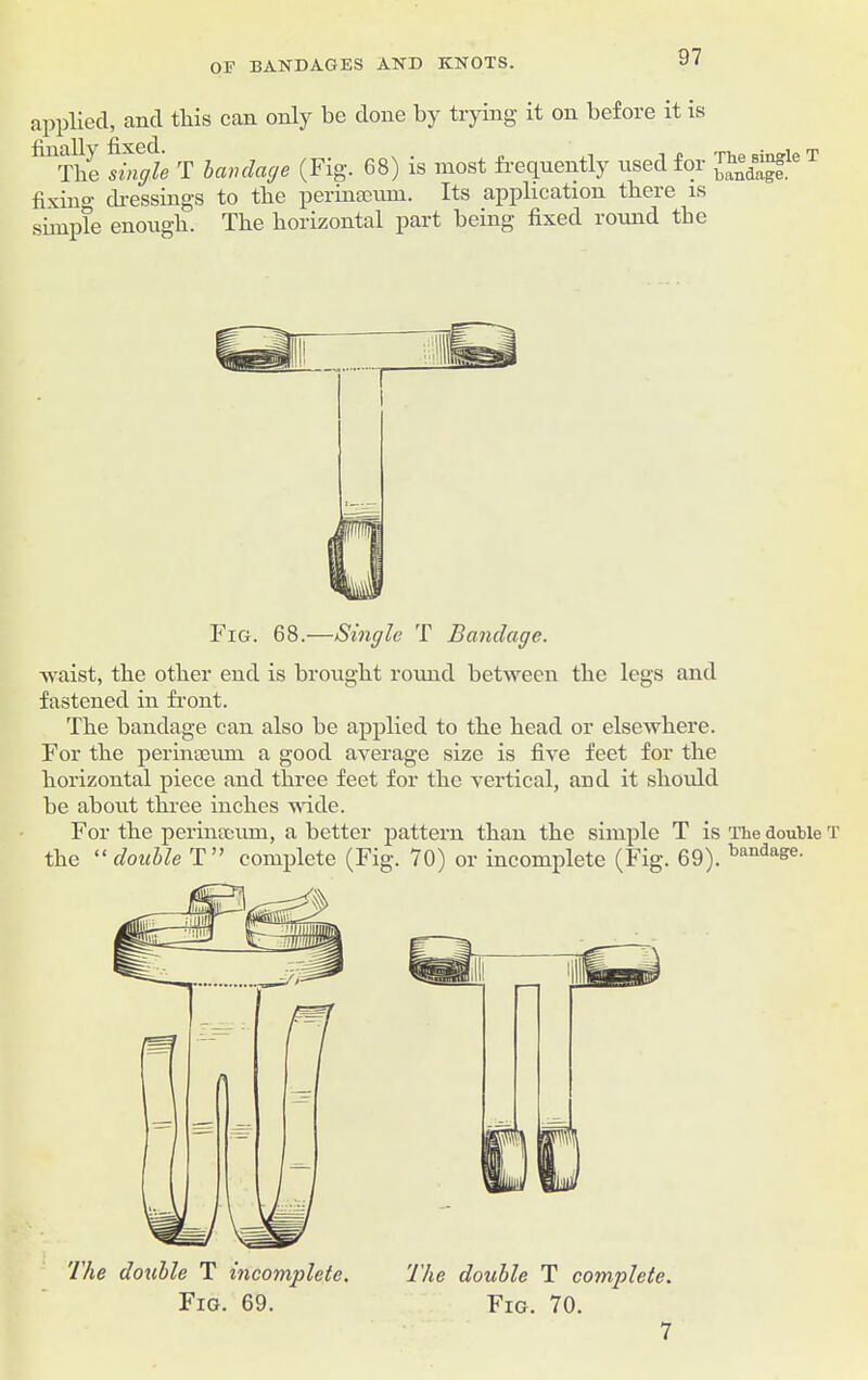 applied, and tliis can only be done by trying it on before it is fil The single T bandage (Fig. 68) is most frequently used for ™8d8^le T fixing dressings to the perinseum. Its application there is simple enough. The horizontal part being fixed roimd the Fig. 68.—Single T Bandage. waist, the other end is brought round between the legs and fastened in front. The bandage can also he applied to the head or elsewhere. For the perinseum a good average size is five feet for the horizontal piece and three feet for the vertical, and it should he about three inches wide. For the perinseum, abetter pattern than the simple T is The double T the “ double T” complete (Fig. 70) or incomplete (Fig. 69). t)an(3a&e- The double T incomplete. The double T complete. Fig. 69. Fig. 70. 7