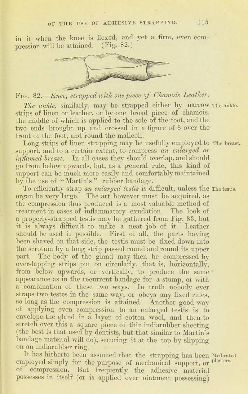 in it when the knee is flexed, and yet a firm, even com- pression will be attained. (Fig, 82.) Fig. 82.—Knee, strapped with one piece of Chamois Leather. The ankle, similarly, may be strapped either by narrow The ankle, strips of linen or leather, or by one broad piece of chamois, the middle of which is applied to the sole of the foot, and the two ends brought up and crossed in a figure of 8 over the front of the foot, and round the malleoli. Long strips of linen strapping may be usefully employed to The breast, support, and to a certain extent, to compress an enlarged or inflamed breast. In all cases they should overlap, and should go from below upwards, but, as a general ride, this kind of support can be much more easily and comfortably maintained bjr the use of “ Martin’s ” rubber bandage. To efficiently strap an enlarged testis is difficult, unless the The testis, organ be very large. The art however must be acquired, as the compression thus produced is a most valuable method of treatment in cases of inflammatory exudation. The look of a properly-strapped testis may be gathered from Fig. 83, but it is always difficult to make a neat job of it. Leather should be used if possible. First of all, the parts having been shaved on that side, the testis must be fixed down into the scrotum by a long strip passed round and round its upper part. The body of the gland may then be compressed by over-lapping strips put on circularly, that is, horizontally, from below upwards, or vertically, to produce the same ' appearance as in the recurrent bandage for a stump, or with a combination of these two ways. In truth nobody ever straps two testes in the same way, or obeys any fixed' rules, so long as the compression is attained. Another good way of applying even compression to an enlarged testis is to envelope the gland in a layer of cotton wool, and then to stretch over this a square piece of thin indiarubber sheeting (the best is that used by dentists, but that similar to Martin’s bandage material will do), securing it at the top by slipping on an indiarubber ring. It has hitherto been assumed that the strapping has been Medicated employed simply for the purpose of mechanical support, or plasters- of compression. But frequently the adhesive material possesses in itself (or is applied over ointment possessing)