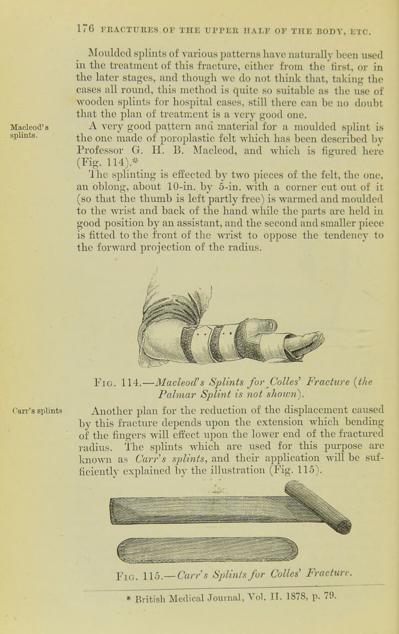 Macleod’s splints. Carr’s splints 176 FRACTURES OF THE UPPER HALF OF THE BODY, ETC. Moulded splints of various patterns have naturally been used in the treatment of this fracture, either from the first, or in the later stages, and though we do not think that, taking the cases all round, this method is quite so suitable as the use of wooden splints for hospital cases, still there can be no doubt that the plan of treatment is a very good one. A very good pattern and material for a moulded splint is the one made of poroplastie felt which has been described by Professor G. H. B. Macleod, and which is figured here (Fig. 114).*. 1 he splinting is effected by two pieces of the felt, the one, an oblong, about 10-in. by 5-in. with a corner cut out of it (so that the thumb is left partly free) is warmed and moulded to the wrist and back of the hand while the parts are held in good position by an assistant, and the second and smaller piece is fitted to the front of the wrist to oppose the tendency to the forward projection of the radius. Fig. 114.—Macleod's Splints for Colies' Fracture {the Palmar Splint is not shown). Another plan for the reduction of the displacement caused by this fracture depends upon the extension which bending of the fingers will effect upon the lower end of the fractured radius. The splints which are used for this piu-pose arc known as Carr's splints, and their application will be suf- ficiently explained by the illustration (Fig. 115). Fig. 115.— Carr's Splints for Colics' Fracture. * British Medical Journal, Vol. IT. 1878, p. 70.