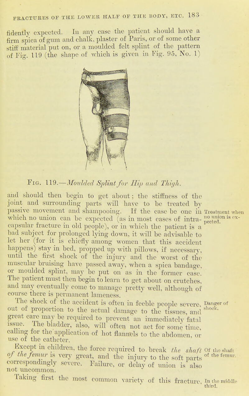 fidently expected. In any case the patient should have a firm spica of gum and chalk, plaster of Paris, or of some other stiff material put on, or a moulded felt splint of the pattern of Fig. 119 (the shape of which is given in Fig. 95, No. 1) Fig. 119.—Moulded Splint for Hip and Thit/h. and should then begin to get about: the stiffness of the joint and surrounding parts will have to be treated by passive movement and shampooing. If the case be one in which no union can be expected (as in most eases of intra- capsular fracture in old people), or in which the patient is a bad subject for prolonged lying down, it will be advisable to let her (for it is chiefly among women that this accident happens) stay in bed, propped up with pillows, if necessary, until the first shock of the injury and the worst of the muscular bruising have passed away, when a spica bandage, oi moulded splint, may be put on as in the former ease. The patient must then begin to learn to get about on crutches, and may eventually come to manage pretty well, although of course there is permanent lameness. 1 lie shock of the accident is often in feeble people severe, out of proportion to the actual damage to the tissues, and great care may be required to prevent an immediately fatal issue. 1 he bladder, also, will often not act for some time, calling for the application of hot flannels to the abdomen, or use of the catheter. Fxccpt in children, the force required to break the shaft of the femur is very great, and the injury to the soft parts correspondingly severe. Failure, or delay of union is also not uncommon. iaking first the most common variety of this fracture. Treatment when no union is ex- pected. Danger of shock. Of the shaft of the femur. In the middle third.