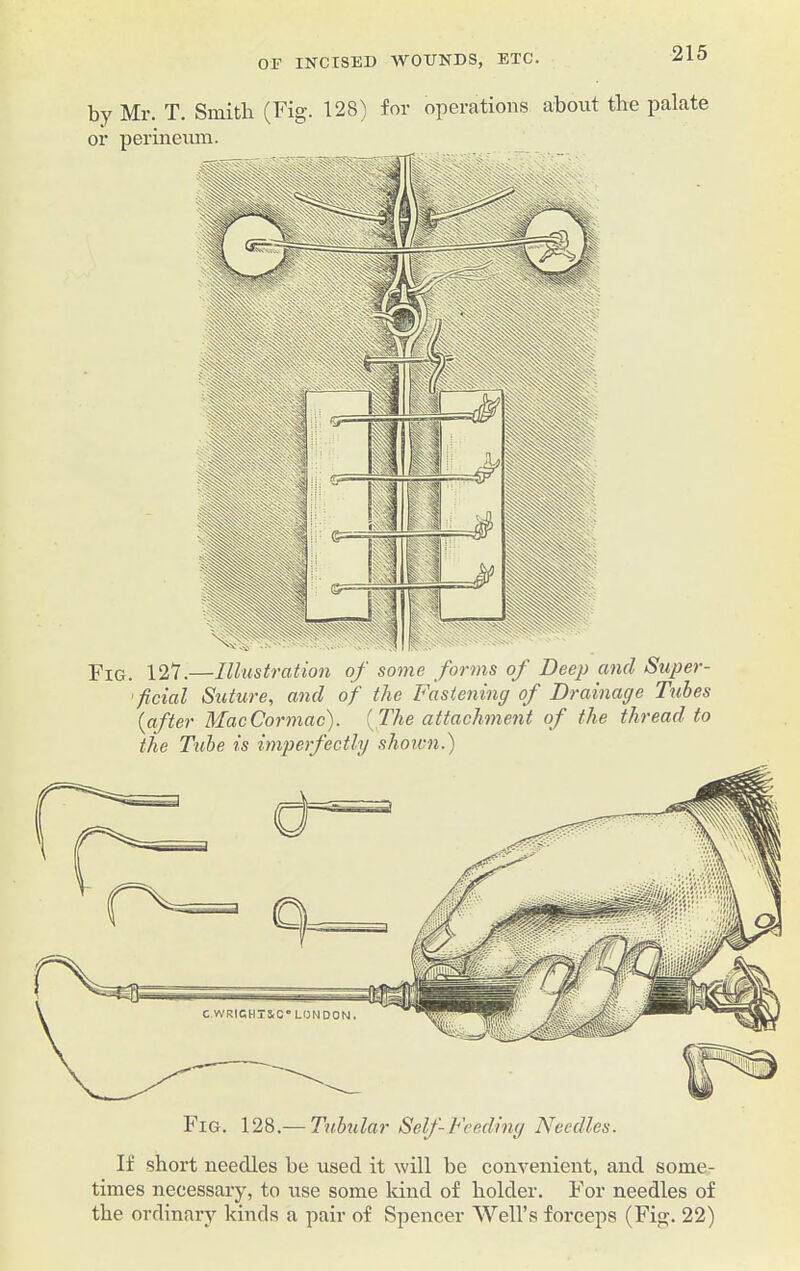 by Mr. T. Smith (Fig. 128) for operations about the palate or jhG< 127.—Illustration of some forms of Deep and Super- -ficial Suture, and of the Fastening of Drainage Tubes {after Mac Cormac). (The attachment of the thread to the Tube is imperfectly shoivn.) Fig. 128.— Tubular Self-Feeding Needles. If short needles be used it will be convenient, and some- times necessary, to use some kind of holder. For needles of the ordinary kinds a pair of Spencer Well’s forceps (Fig. 22)