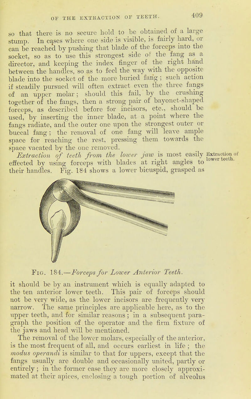 so that there is no secure hold to be obtained of a large stump. In cases where one side is visible, is fairly hard, or can be reached by pushing that blade of the forceps into the socket, so as to use this strongest side of the fang as a director, and keeping the index finger of the right hand between the handles, so as to feel the way with the opposite hlade into the socket of the more buried fang ; such action if steadily pursued will often extract even the three fangs of an upper molar; should this fail, by the crushing together of the fangs, then a strong pair of bayonet-shaped forceps, as described before for incisors, etc., should be used, by inserting the inner blade, at a point where the fangs radiate, and the outer one upon the strongest outer or buccal fang; the removal of one fang will leave ample space for reaching the rest, pressing them towards the space vacated by the one removed. Extraction of teeth from the lower jaw is most easily EstiacUou of effected by using forceps with blades at right angles to 0W,JI their handles. Fig. 184 shows a lower bicuspid, grasped as Fig. 184.—Forceps for Lower Anterior Teeth. it should be by an instrument which is equally adapted to the ten anterior lower teeth. This pair of forceps should not be very wide, as the lower incisors are frequently very narrow. The same principles are applicable here, as to the upper teeth, and for similar reasons ; in a subsequent para- graph the position of the operator and the firm fixture of the jaws and head will be mentioned. The removal of the lower molars, especially of the anterior, is the most frequent of all, and occurs earliest in life ; the modus operandi is similar to that for uppers, except that the fangs usually are double and occasionally united, partly or entirely ; in the former ease they are more closely approxi- mated at their apices, enclosing a tough portion of alveolus