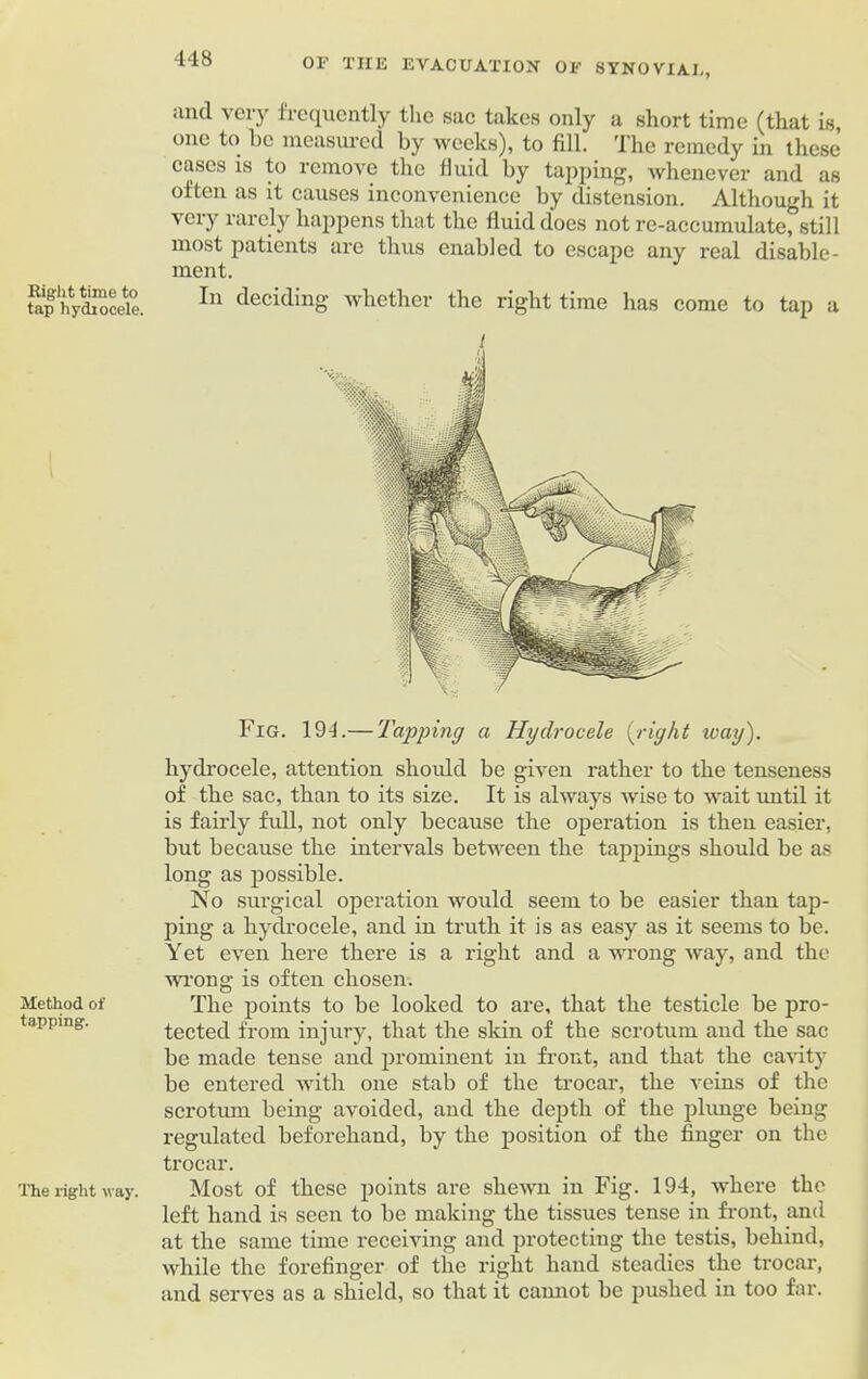 Bight time to tap hydrocele. Method of tapping. The right way. OF TIIE EVACUATION OF SYNOVIAL, <incl very frequently the sac takes only a short time (that is, one to be measured by weeks), to fill. The remedy in these cases is to remove the fluid by tapping, whenever and as often as it causes inconvenience by distension. Although it very rarely happens that the fluid does not re-accumulate, still most patients are thus enabled to escape any real disable- ment. In deciding whether the right time has come to tap a Fig. 194.— Tapping a Hydrocele {right ivay). hydrocele, attention should be given rather to the tenseness of the sac, than to its size. It is always wise to wait until it is fairly full, not only because the operation is then easier, but because the intervals between the tappings should be as long as possible. No surgical operation would seem to be easier than tap- ping a hydrocele, and in truth it is as easy as it seems to be. Yet even here there is a right and a wrong way, and the wrong is often chosen. The points to be looked to are, that the testicle be pro- tected from injury, that the skin of the scrotum and the sac be made tense and prominent in front, and that the cavity be entered -with one stab of the trocar, the veins of the scrotum being avoided, and the depth of the plunge being regulated beforehand, by the position of the finger on the trocar. Most of these points are shewn in Fig. 194, where the left hand is seen to be making the tissues tense in front, and at the same time receiving and protecting the testis, behind, while the forefinger of the right hand steadies the trocar, and serves as a shield, so that it cannot be pushed in too far.