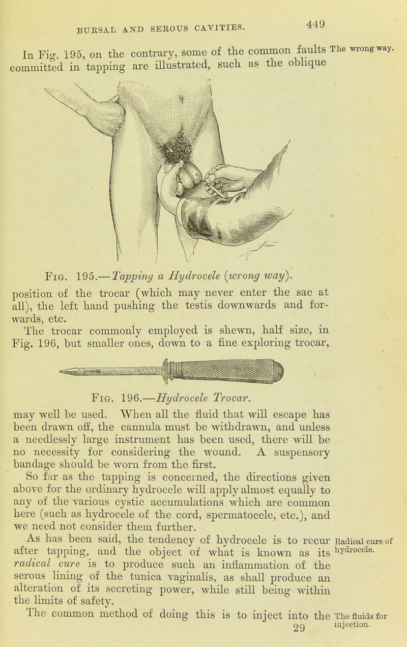 In Fi<>\ 195, on tlie contrary, some of tlie common faults The -wrong way. committed in tapping are illustrated, sucli as the oblique Fig. 195.—Tapping a Hydrocele (wrong icay). position of the trocar (which may never enter the sac at all), the left hand pushing the testis downwards and for- wards, etc. The trocar commonly employed is shewn, half size, in Fig. 196, but smaller ones, down to a fine exploring trocar, Fig. 196.—Hydrocele Trocar. may well be used. When all the fluid that will escape has been drawn off, the cannula must be withdrawn, and unless a needlessly large instrument has been used, there will be no necessity for considering the wound. A suspensory bandage should be worn from the first. So far as the tapping is concerned, the directions given above for the ordinary hydrocele will apply almost equally to any of the various cystic accumulations which are common here (such as hydrocele of the cord, spermatocele, etc.), and we need not consider them further. As has been said, the tendency of hydrocele is to recur Radical cure of after tapping, and the object of what is known as its liydrocele- radioed cure is to produce such an inflammation of the serous lining of the tunica vaginalis, as shall produce an alteration of its secreting power, while still being within the limits of safety. The common method of doing this is to inject into the The fluids for nq injection.