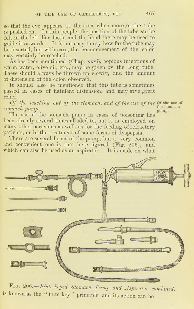 so that the eye appears at the anus when more of the tube is pushed on. In thin people, the position of the tube can be felt in the left iliac fossa, and the hand there may be used to guide it onwards. It is not easy to say how far the tube may be inserted, but with care, the commencement of the colon may certainly be reached. As has been mentioned (Chap, xxvi), copious injections of warm water, olive oil, etc., may be given by the long tube. These should always be thrown up slowly, and the amount of distension of the colon observed. It should also be mentioned that this tube is sometimes passed in cases of flatulent distension, and may give great relief. Of the washing out of the stomach, and of the use of the Of the vise stomach pump. limp0”1'1 The use of the stomach pump in cases of poisoning has been already several times alluded to, but it is employed on many other occasions as well, as for the feeding of refractory patients, or in the treatment of some forms of dyspepsia. There are several forms of the pump, but a very common and convenient one is that here figured (Fig. 206), and which can also be used as an aspirator. It is made on what Iig. 206. Flute-keyed Stomach Pump and Aspirator combined. is known as the “ flute key” principle, and its action can be