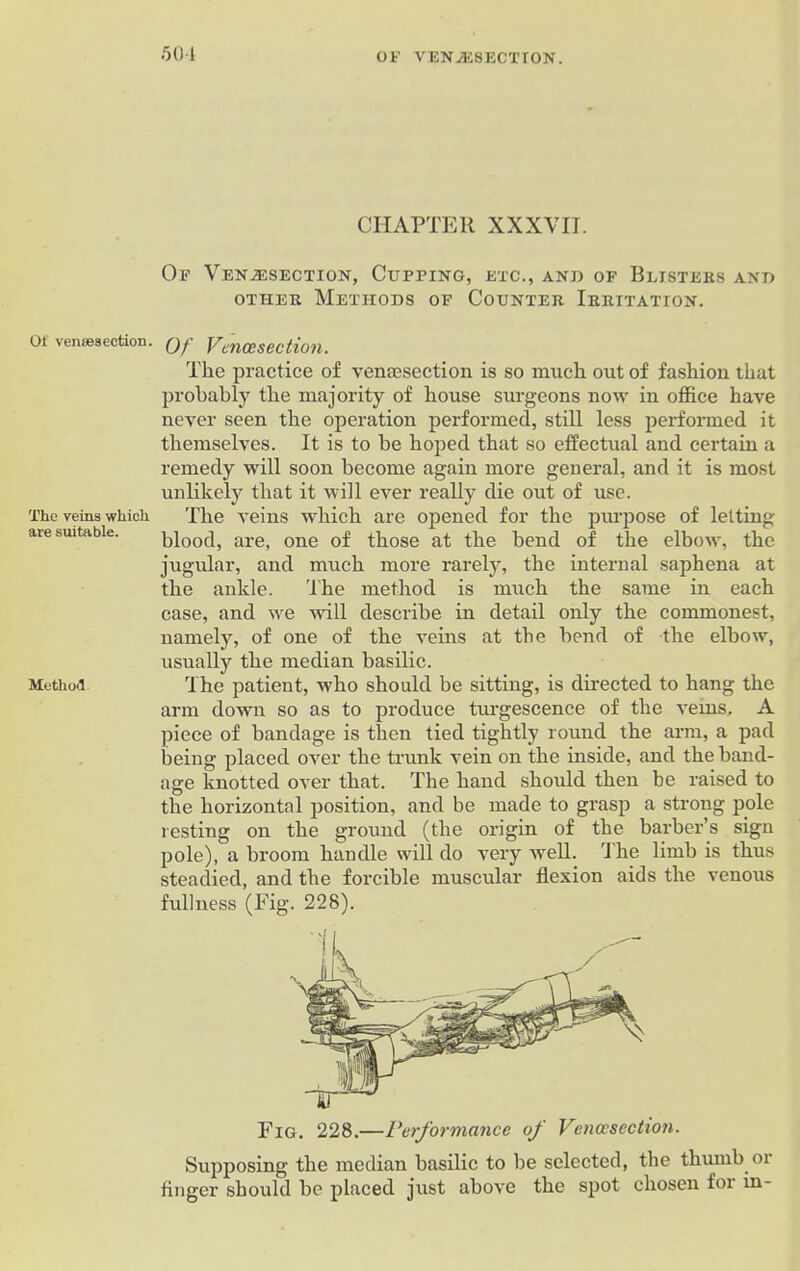 501 Of vensesection. The veins which are suitable. Method CHAPTER XXXVII. Of Venesection, Cupping, etc., and of Blisters and other Methods of Counter Irritation. Of Venesection. The practice of vemesection is so much out of fashion that probably the majority of house surgeons now in office have never seen the operation performed, still less performed it themselves. It is to be hoped that so effectual and certain a remedy will soon become again more general, and it is most unlikely that it will ever really die out of use. The veins which are opened for the purpose of letting blood, are, one of those at the bend of the elbow, the jugular, and much more rarely, the internal saphena at the ankle. The method is much the same in each case, and we will describe in detail only the commonest, namely, of one of the veins at the bend of the elbow, usually the median basilic. The patient, who should be sitting, is directed to hang the arm down so as to produce tiu-gescence of the veins, A piece of bandage is then tied tightly round the arm, a pad being placed over the trunk vein on the inside, and the band- age knotted over that. The hand should then be raised to the horizontal position, and be made to grasp a strong pole resting on the ground (the origin of the barber’s sign pole), a broom handle will do very well. The limb is thus steadied, and the forcible muscular flexion aids the venous fullness (Fig. 228). Fig. 228.—Performance of Venesection. Supposing the median basilic to be selected, the thumb or linger should be placed just above the spot chosen for in-