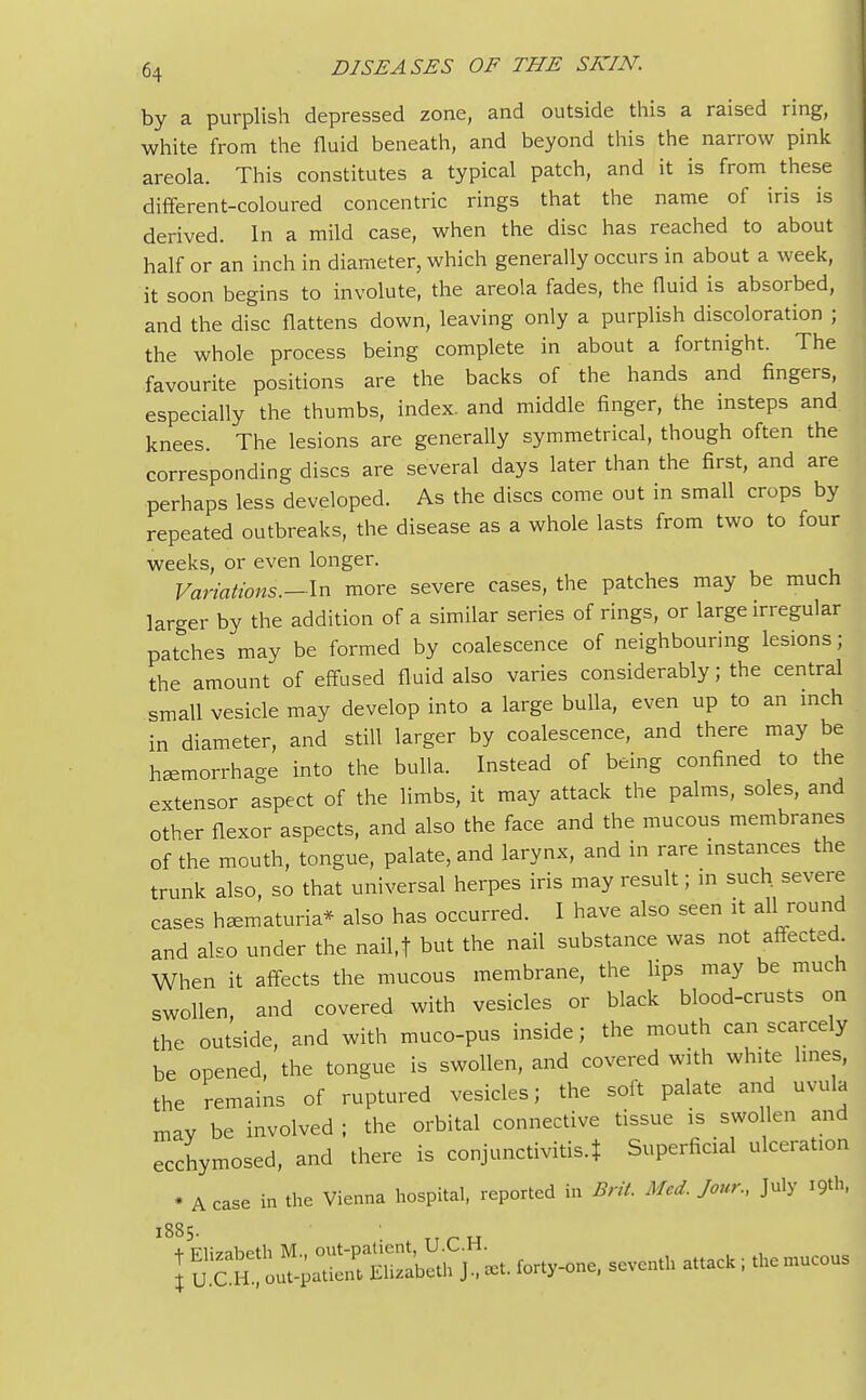 by a purplish depressed zone, and outside this a raised ring, white from the fluid beneath, and beyond this the narrow pink areola. This constitutes a typical patch, and it is from these different-coloured concentric rings that the name of iris is derived. In a mild case, when the disc has reached to about half or an inch in diameter, which generally occurs in about a week, it soon begins to involute, the areola fades, the fluid is absorbed, and the disc flattens down, leaving only a purplish discoloration ; the whole process being complete in about a fortnight. The favourite positions are the backs of the hands and fingers, especially the thumbs, index, and middle finger, the insteps and knees. The lesions are generally symmetrical, though often the corresponding discs are several days later than the first, and are perhaps less developed. As the discs come out in small crops by repeated outbreaks, the disease as a whole lasts from two to four weeks, or even longer. Variations.—In more severe cases, the patches may be much larger by the addition of a similar series of rings, or large irregular patches may be formed by coalescence of neighbouring lesions; the amount of effused fluid also varies considerably; the central small vesicle may develop into a large bulla, even up to an inch in diameter, and still larger by coalescence, and there may be hemorrhage into the bulla. Instead of being confined to the extensor aspect of the limbs, it may attack the palms, soles, and other flexor aspects, and also the face and the mucous membranes of the mouth, tongue, palate, and larynx, and in rare instances the trunk also, so that universal herpes iris may result; in such severe cases hematuria* also has occurred. I have also seen it all round and also under the nail.t but the nail substance was not affected When it affects the mucous membrane, the lips may be much swollen, and covered with vesicles or black blood-crusts on the outside, and with muco-pus inside; the mouth can scarcely be opened, the tongue is swollen, and covered with white lines, the remains of ruptured vesicles; the soft palate and uvula mav be involved ; the orbital connective tissue is swollen and ecchymosed, and there is conjunctivitis.? Superficial ulceration * A case in the Vienna hospital, reported in Brit. Med. Jour., July i9th, ^^Ji&^i^^ ~—-ck; the mucous