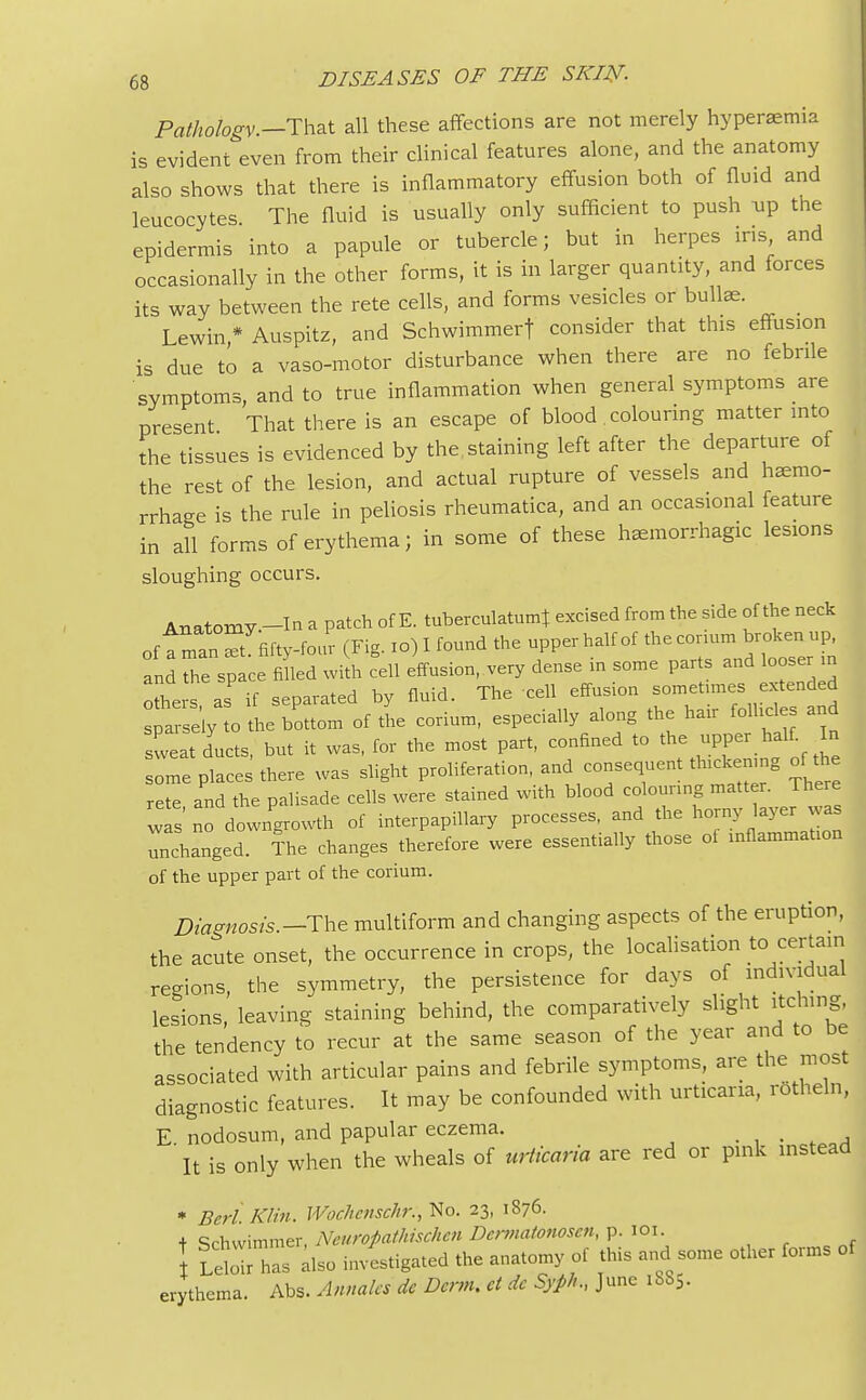 Pathology.—That all these affections are not merely hyperemia is evident even from their clinical features alone, and the anatomy also shows that there is inflammatory effusion both of fluid and leucocytes The fluid is usually only sufficient to push up the epidermis into a papule or tubercle; but in herpes ins and occasionally in the other forms, it is in larger quantity, and forces its way between the rete cells, and forms vesicles or bullae. Lewin * Auspitz, and Schwimmerf consider that this effusion is due to a vaso-motor disturbance when there are no febrile symptoms, and to true inflammation when general symptoms are present That there is an escape of blood colouring matter into the tissues is evidenced by the staining left after the departure of the rest of the lesion, and actual rupture of vessels and hemo- rrhage is the rule in peliosis rheumatica, and an occasional feature in all forms of erythema; in some of these hemorrhagic lesions sloughing occurs. Anatomy-In a patch of E. tuberculatum} excised from the side of the neck of a man S fifty-four (Fig. 10) I found the upper half of the conum broken up, and Z space filled with cell effusion, very dense in some parts and looser m nLrs as if separated by fluid. The cell effusion sometimes extended se'ly o L bottom of the corium, especially along the hair follicles and sweat ducts, but it was, for the most part, confined to the upper half In ome places there was slight proliferation, and consequent thickening tfthe rete and the palisade cells were stained with blood colounng matter. There was no down'growth of interpapillary processes, and the horny layer was unchanged. The changes therefore were essentially those ot xnQammation of the upper part of the corium. Diagnosis.—The multiform and changing aspects of the eruption, the acute onset, the occurrence in crops, the localisation to^certain regions, the symmetry, the persistence for days of individual lesions, leaving staining behind, the comparatively slight itching, the tendency to recur at the same season of the year and to be associated with articular pains and febrile symptoms, are the most diagnostic features. It may be confounded with urticaria, rotheln, E. nodosum, and papular eczema. , It is only when the wheals of urticaria are red or pink instead * Berl. Klin. Wochenschr:, No. 23, 1876. + e?rhwimmer Neuropathischen Dermatonosen, p. 101. LeSTs alfo investigated the anatomy of this and some other forms of erythema. Abs. Annates do Derm, et de Syph., June 1885.