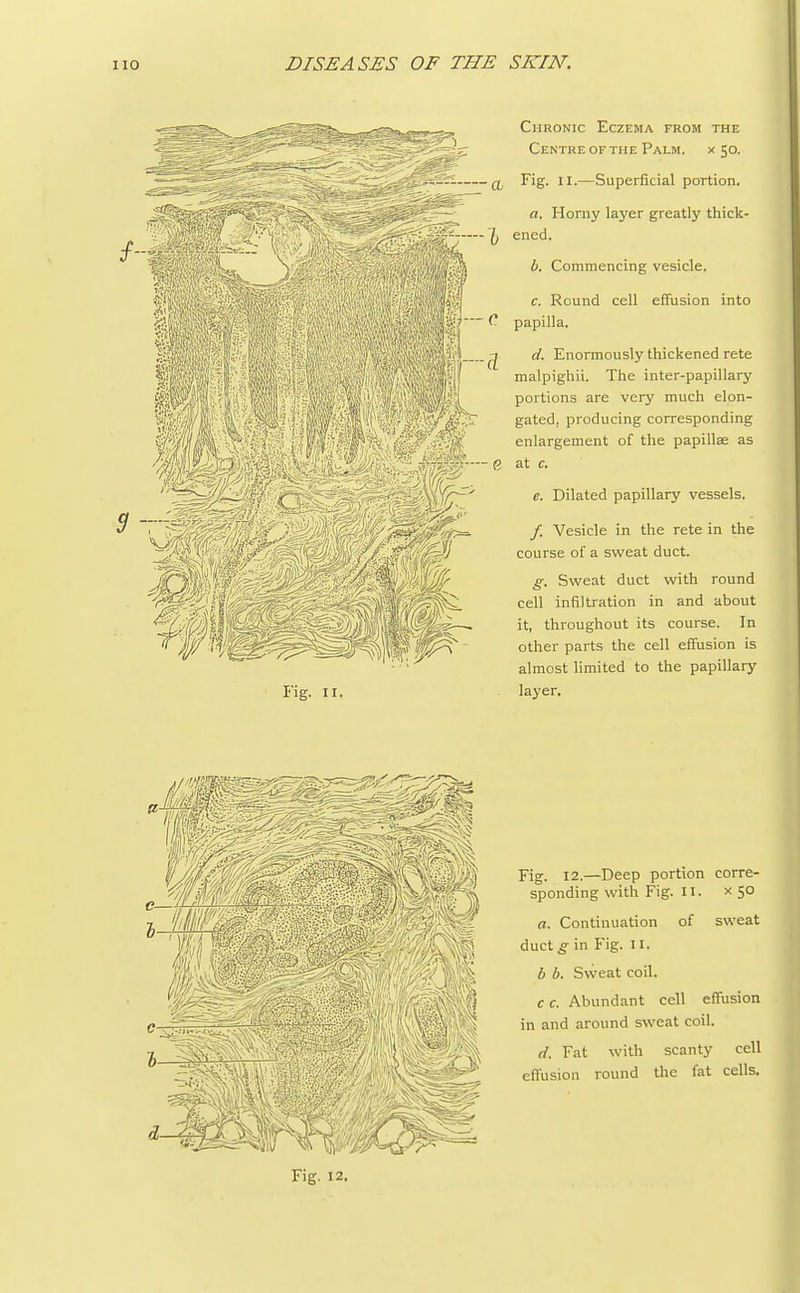 a Chronic Eczema from the Centre of the Palm. x 50. Fig. II.—Superficial portion. Fig. II. a. Horny layer greatly thick- 1) ened. b. Commencing vesicle. c. Round cell effusion into papilla. d. Enormously thickened rete malpighii. The inter-papillary portions are very much elon- gated, producing corresponding enlargement of the papillae as 0 at c. e. Dilated papillary vessels. /. Vesicle in the rete in the course of a sweat duct. g. Sweat duct with round cell infiltration in and about it, throughout its course. In other parts the cell effusion is almost limited to the papillary layer. W Fig. 12.—Deep portion corre- sponding with Fig. 11. x 50 a. Continuation of sweat duct g in Fig. II. b b. Sweat coil. c c. Abundant cell effusion in and around sweat coil. d. Fat with scanty cell effusion round the fat cells. Fig. 12.