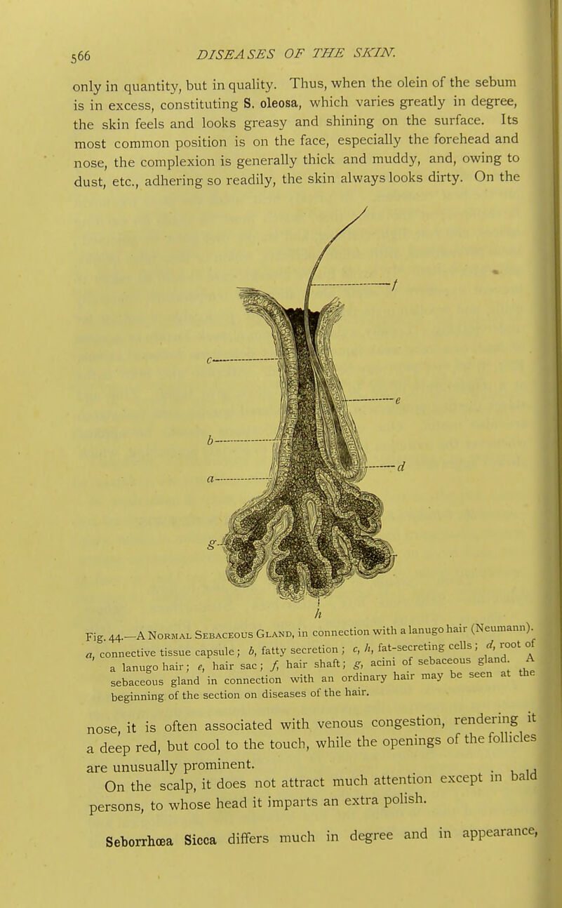 only in quantity, but in quality. Thus, when the olein of the sebum is in excess, constituting S. oleosa, which varies greatly in degree, the skin feels and looks greasy and shining on the surface. Its most common position is on the face, especially the forehead and nose, the complexion is generally thick and muddy, and, owing to dust, etc., adhering so readily, the skin always looks dirty. On the d Fig 44.-A Normal Sebaceous Gland, in connection with a lanugo hair (Neumann). a, connective tissue capsule; b, fatty secretion ; c, ft, fat-secreting cells ; d, root of a lanugo hair; hair sac; / hair shaft; g, acini of sebaceous gland A sebaceous gland in connection with an ordinary ha.r may be seen at the beginning of the section on diseases of the hair. nose, it is often associated with venous congestion, rendering it a deep red, but cool to the touch, while the openings of the follicles are unusually prominent. _ On the scalp, it does not attract much attention except in bald persons, to whose head it imparts an extra polish. Seborrhea Sicca differs much in degree and in appearance,