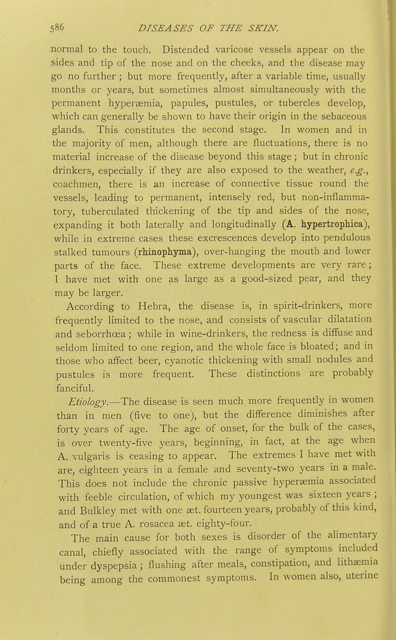 normal to the touch. Distended varicose vessels appear on the sides and tip of the nose and on the cheeks, and the disease may go no further; but more frequently, after a variable time, usually months or years, but sometimes almost simultaneously with the permanent hypersemia, papules, pustules, or tubercles develop, which can generally be shown to have their origin in the sebaceous glands. This constitutes the second stage. In women and in the majority of men, although there are fluctuations, there is no material increase of the disease beyond this stage; but in chronic drinkers, especially if they are also exposed to the weather, e.g., coachmen, there is an increase of connective tissue round the vessels, leading to permanent, intensely red, but non-inflamma- tory, tuberculated thickening of the tip and sides of the nose, expanding it both laterally and longitudinally (A. hypertrophica), while in extreme cases these excrescences develop into pendulous stalked tumours (rhinophyma), over-hanging the mouth and lower parts of the face. These extreme developments are very rare; I have met with one as large as a good-sized pear, and they may be larger. According to Hebra, the disease is, in spirit-drinkers, more frequently limited to the nose, and consists of vascular dilatation and seborrhcea ; while in wine-drinkers, the redness is diffuse and seldom limited to one region, and the whole face is bloated; and in those who affect beer, cyanotic thickening with small nodules and pustules is more frequent. These distinctions are probably fanciful. Etiology.—The disease is seen much more frequently in women than in men (five to one), but the difference diminishes after forty years of age. The age of onset, for the bulk of the cases, is over twenty-five years, beginning, in fact, at the age when A. vulgaris is ceasing to appear. The extremes I have met with are, eighteen years in a female and seventy-two years in a male. This does not include the chronic passive hypersemia associated with feeble circulation, of which my youngest was sixteen years ; and Bulkley met with one aet. fourteen years, probably of this kind, and of a true A. rosacea aet. eighty-four. The main cause for both sexes is disorder of the alimentary canal, chiefly associated with the range of symptoms included under dyspepsia ; flushing after meals, constipation, and lithaemia being among the commonest symptoms. In women also, uterine