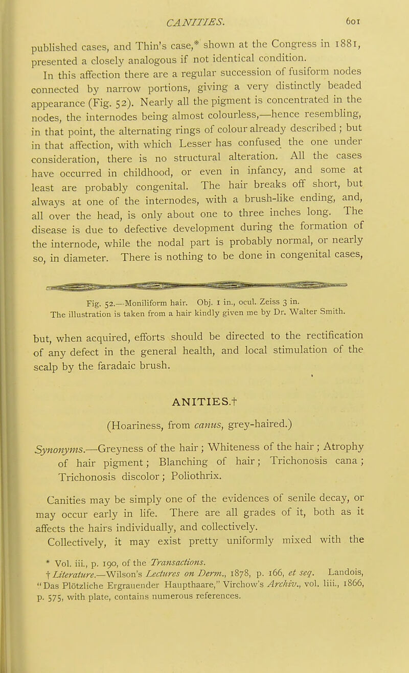 published cases, and Thin's case,* shown at the Congress in 1881, presented a closely analogous if not identical condition. In this affection there are a regular succession of fusiform nodes connected by narrow portions, giving a very distinctly beaded appearance (Fig. 52). Nearly all the pigment is concentrated in the nodes, the internodes being almost colourless—hence resembling, in that point, the alternating rings of colour already described ; but in that affection, with which Lesser has confused the one under consideration, there is no structural alteration. All the cases have occurred in childhood, or even in infancy, and some at least are probably congenital. The hair breaks off short, but always at one of the internodes, with a brush-like ending, and, all over the head, is only about one to three inches long.^ The disease is due to defective development during the formation of the internode, while the nodal part is probably normal, or nearly so, in diameter. There is nothing to be done in congenital cases, Fig. 52.—Moniliform hair. Obj. I in., ocul. Zeiss 3 in. The illustration is taken from a hair kindly given me by Dr. Walter Smith. but, when acquired, efforts should be directed to the rectification of any defect in the general health, and local stimulation of the scalp by the faradaic brush. ANITIES.t (Hoariness, from canus, grey-haired.) Synonyms.—Greyness of the hair; Whiteness of the hair; Atrophy of hair pigment; Blanching of hair; Trichonosis cana; Trichonosis discolor; Poliothrix. Canities may be simply one of the evidences of senile decay, or may occur early in life. There are all grades of it, both as it affects the hairs individually, and collectively. Collectively, it may exist pretty uniformly mixed with the * Vol. iii., p. 190, of the Transactions. tLiterature—-Wilson's Lectures on Derm., 1878, p. 166, et seq. Landois, Das Plotzliche Ergrauender Haupthaare, Virchow's Archiv., vol. liii., 1866, P- 575, with plate, contains numerous references.