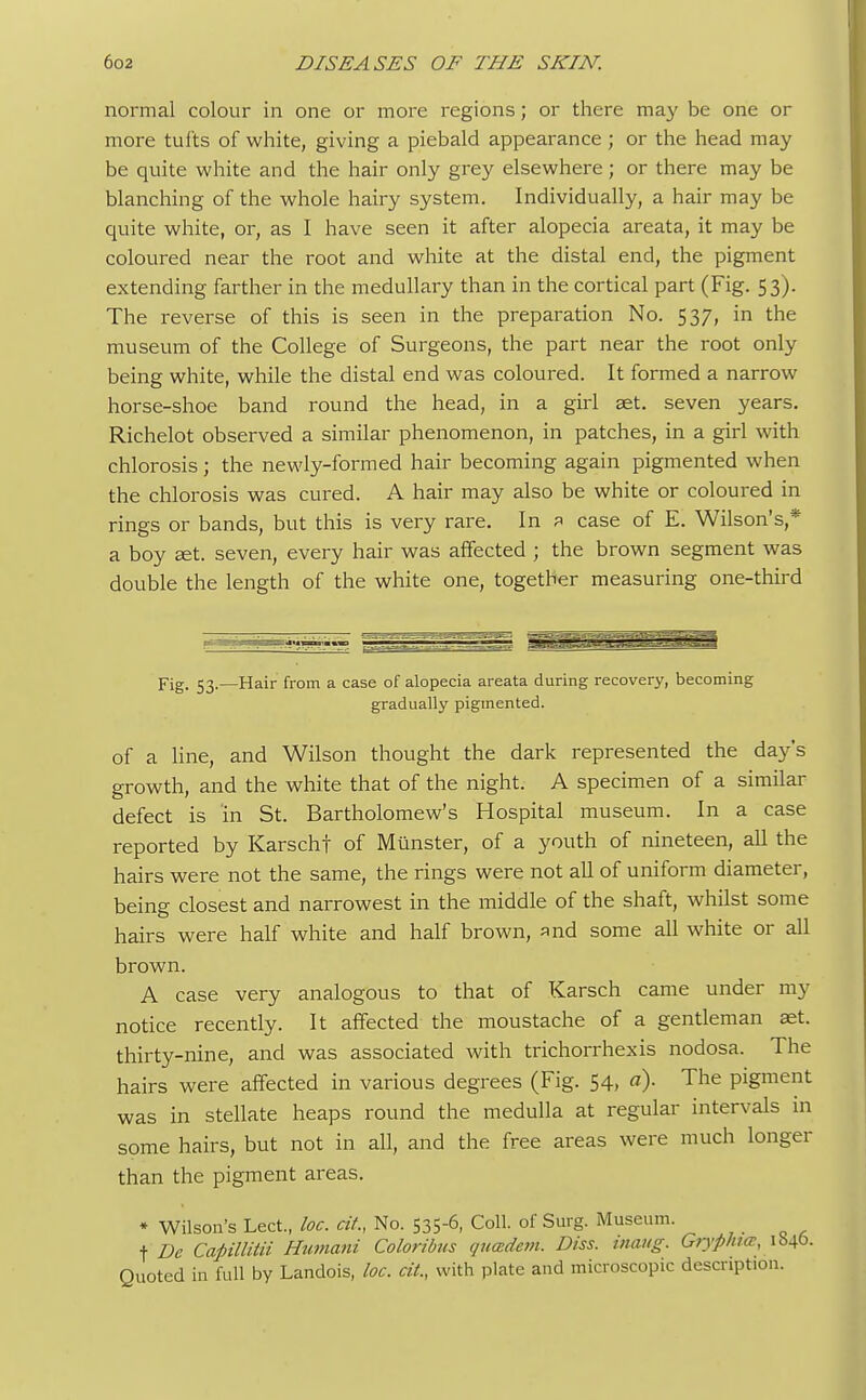 normal colour in one or more regions; or there may be one or more tufts of white, giving a piebald appearance; or the head may be quite white and the hair only grey elsewhere; or there may be blanching of the whole hairy system. Individually, a hair may be quite white, or, as I have seen it after alopecia areata, it may be coloured near the root and white at the distal end, the pigment extending farther in the medullary than in the cortical part (Fig. 53). The reverse of this is seen in the preparation No. 537, in the museum of the College of Surgeons, the part near the root only being white, while the distal end was coloured. It formed a narrow horse-shoe band round the head, in a girl set. seven years. Richelot observed a similar phenomenon, in patches, in a girl with chlorosis j the newly-formed hair becoming again pigmented when the chlorosis was cured. A hair may also be white or coloured in rings or bands, but this is very rare. In ? case of E. Wilson's,* a boy set. seven, every hair was affected ; the brown segment was double the length of the white one, together measuring one-third Fig. 53.—Hair from a case of alopecia areata during recovery, becoming gradually pigmented. of a line, and Wilson thought the dark represented the day's growth, and the white that of the night. A specimen of a similar defect is in St. Bartholomew's Hospital museum. In a case reported by Karscht of Minister, of a youth of nineteen, all the hairs were not the same, the rings were not all of uniform diameter, being closest and narrowest in the middle of the shaft, whilst some hairs were half white and half brown, and some all white or all brown. A case very analogous to that of Karsch came under my notice recently. It affected the moustache of a gentleman set. thirty-nine, and was associated with trichorrhexis nodosa. The hairs were affected in various degrees (Fig. 54, a). The pigment was in stellate heaps round the medulla at regular intervals in some hairs, but not in all, and the free areas were much longer than the pigment areas. * Wilson's Lect., loc. at., No. 535-6, Coll. of Surg. Museum, f De CaUllitii Humani Coloribus qucedem. Diss. maug. Gryphun, 1840. Quoted in full by Landois, loc. tit., with plate and microscopic description.