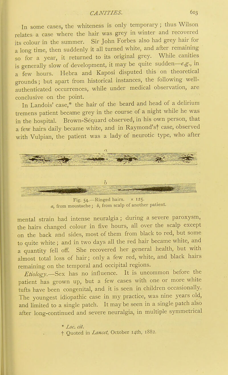 In some cases, the whiteness is only temporary ; thus Wilson relates a case where the hair was grey in winter and recovered its colour in the summer. Sir John Forbes also had grey hair for a long time, then suddenly it all turned white, and after remaining so for a year, it returned to its original grey. While canities is generally slow of development, it may be quite sudden—e.g., in a few hours. Hebra and Kaposi disputed this on theoretical grounds; but apart from historical instances, the following well- authenticated occurrences, while under medical observation, are conclusive on the point. In Landois' case* the hair of the beard and head of a delirium tremens patient became grey in the course of a night while he was in the hospital. Brown-Sequard observed, in his own person, that a few hairs daily became white, and in Raymond's! case, observed with Vulpian, the patient was a lady of neurotic type, who after Fig. 54.—Ringed hairs. x 125. a, from moustache; b, from scalp of another patient. mental strain had intense neuralgia; during a severe paroxysm, the hairs changed colour in five hours, all over the scalp except on the back and sides, most of them from black to red, but some to quite white; and in two days all the red hair became white, and a quantity fell off. She recovered her general health, but with almost total loss of hair; only a few red, white, and black hairs remaining on the temporal and occipital regions. Etiology.—Sex has no influence. It is uncommon before the patient has grown up, but a few cases with one or more white tufts have been congenital, and it is seen in children occasionally. The youngest idiopathic case in my practice, was nine years old, and limited to a single patch. It may be seen in a single patch also after long-continued and severe neuralgia, in multiple symmetrical * Loc. tit. t Quoted in Lancet, October 14th, 1882.