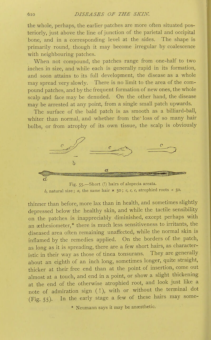 the whole, perhaps, the earlier patches are more often situated pos- teriorly, just above the line of junction of the parietal and occipital bone, and in a corresponding level at the sides. The shape is primarily round, though it may become irregular by coalescence with neighbouring patches. When not compound, the patches range from one-half to two inches in size, and while each is generally rapid in its formation, and soon attains to its full development, the disease as a whole may spread very slowly. There is no limit to the area of the com- pound patches, and by the frequent formation of new ones, the whole scalp and face may be denuded. On the other hand, the disease may be arrested at any point, from a single small patch upwards. The surface of the bald patch is as smooth as a billiard-ball, whiter than normal, and whether from the' loss of so many hair bulbs, or from atrophy of its own tissue, the scalp is obviously b Fig. 55.—Short (!) hairs of alopecia areata. b, natural size; a, the same hair x 50; c, c, c, atrophied roots x 50. thinner than before, more lax than in health, and sometimes slightly depressed below the healthy skin, and while the tactile sensibility on the patches is inappreciably diminished, except perhaps with an Eethesiometer,* there is much less sensitiveness to irritants, the diseased area often remaining unaffected, while the normal skin is inflamed by the remedies applied. On the borders of the patch, as long as it is spreading, there are a few short hairs, as character- istic in their way as those of tinea tonsurans. They are generally about an eighth of an inch long, sometimes longer, quite straight, thicker at their free end than at the point of insertion, come out almost at a touch, and end in a point, or show a slight thickening at the end of the otherwise atrophied root, and look just like a note of admiration sign ( !), with or without the terminal dot (Fig. 55). In the early stage a few of these hairs may some- * Neumann says it may be anaesthetic.