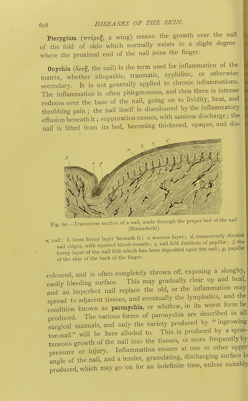 Pterygium (irrkpvt a wing) means the growth over the nail of the fold of skin which normally exists in a slight degree where the proximal end of the nail joins the finger. Onychia (6W£, the nail) is the term used for inflammation of the matrix, whether idiopathic, traumatic, syphilitic, or otherwise secondary. It is not generally applied to chronic inflammations. The inflammation is often phlegmonous, and then there is intense redness over the base of the nail, going on to lividity, heat, and throbbing pain ; the nail itself is discoloured by the inflammatory effusion beneath it; suppuration ensues, with samous discharge ; the nail is lifted from its bed, becoming thickened, opaque, and dis- Fig. 6o.-Transverse section of a nail, made through the proper bed of the nail (Biesiadecki). a nail- b, loose horny layer beneath it; c, mucous layer; d transversely divided na 1 , dges, with injected blood-vessels; e, nail fold destitute of papdte i / he horny layer of the nail fold which has been deposited upon the nau; g, papilla of the skin of the back of the finger. coloured, and is often completely thrown off, exposing a sloughy easil bleeding surface. This may gradually clear up and heal, and an imperfect nail replace the old, or the inflammation may spread to adjacent tissues, and eventually the lymphatics, and the condition known as paronychia, or whitlow, in its worst form be produced The various forms of paronychia are described in all surgical manuals, and only the variety produced by ingrowing toe nail will be here alluded to. This is produced by a spon- taneous growth of the nail into the tissues, or more frequently by pressure or injury. Inflammation ensues at one or other upper angle of the nail, and a tender, granulating, discharging surface s produced, which may go on for an indefinite time, unless suitably