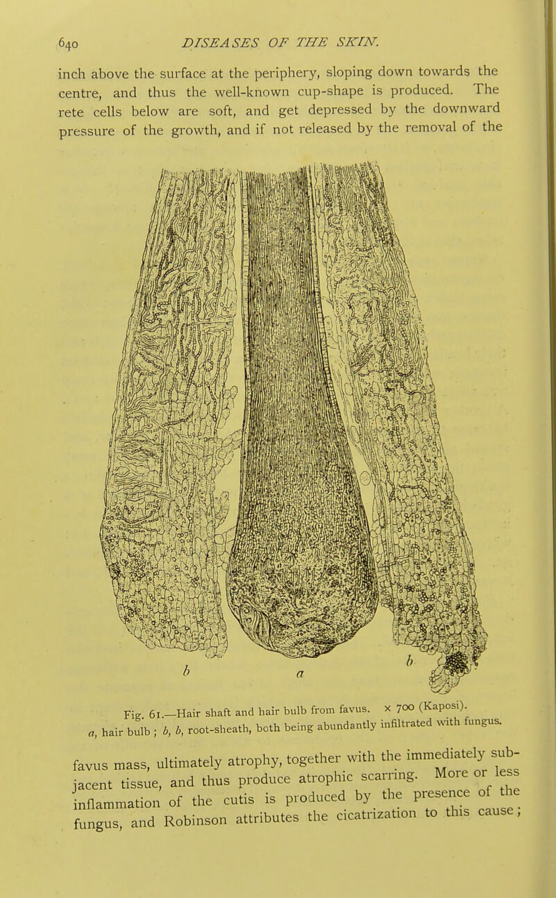 inch above the surface at the periphery, sloping down towards the centre, and thus the well-known cup-shape is produced. The rete cells below are soft, and get depressed by the downward pressure of the growth, and if not released by the removal of the Fi„ 61 -Hair shaft and hair bulb from favus. x 700 (Kaposi). a, hair bulb ; b, b, root-sheath, both being abundantly infiltrated with fungus. favus mass, ultimately atrophy, together with the jacent tissue, and thus produce atrophic scarnng. More or less inflammation of the cutis is produced by the presence of the fungus, and Robinson attributes the cicatrization to this cause,
