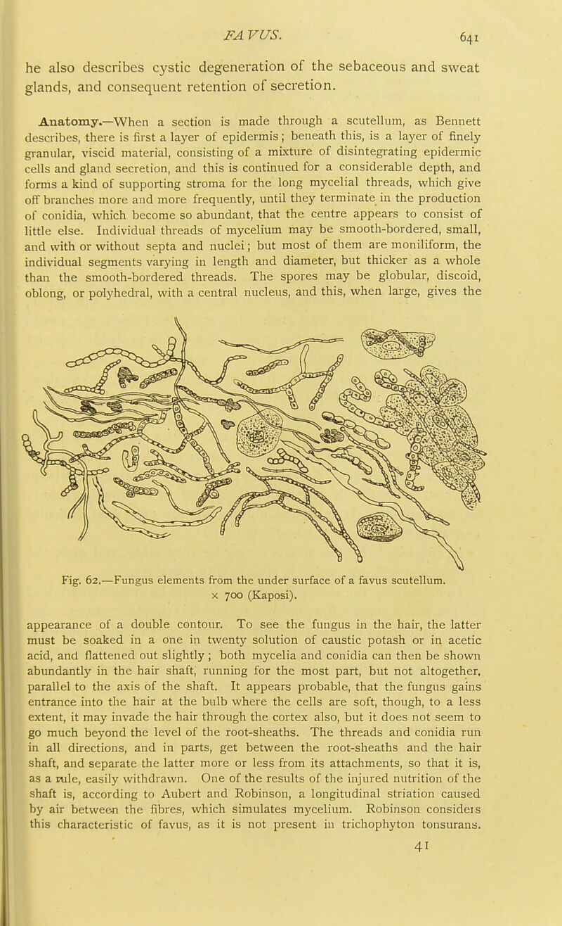 he also describes cystic degeneration of the sebaceous and sweat glands, and consequent retention of secretion. Anatomy.—When a section is made through a scutellum, as Bennett describes, there is first a layer of epidermis; beneath this, is a layer of finely granular, viscid material, consisting of a mixture of disintegrating epidermic cells and gland secretion, and this is continued for a considerable depth, and forms a kind of supporting stroma for the long mycelial threads, which give off branches more and more frequently, until they terminate in the production of conidia, which become so abundant, that the centre appears to consist of little else. Individual threads of mycelium may be smooth-bordered, small, and with or without septa and nuclei; but most of them are moniliform, the individual segments varying in length and diameter, but thicker as a whole than the smooth-bordered threads. The spores may be globular, discoid, oblong, or polyhedral, with a central nucleus, and this, when large, gives the Fig. 62,—Fungus elements from the under surface of a favus scutellum. x 700 (Kaposi). appearance of a double contour. To see the fungus in the hair, the latter must be soaked in a one in twenty solution of caustic potash or in acetic acid, and flattened out slightly ; both mycelia and conidia can then be shown abundantly in the hair shaft, running for the most part, but not altogether, parallel to the axis of the shaft. It appears probable, that the fungus gains entrance into the hair at the bulb where the cells are soft, though, to a less extent, it may invade the hair through the cortex also, but it does not seem to go much beyond the level of the root-sheaths. The threads and conidia run in all directions, and in parts, get between the root-sheaths and the hair shaft, and separate the latter more or less from its attachments, so that it is, as a rule, easily withdrawn. One of the results of the injured nutrition of the shaft is, according to Aubert and Robinson, a longitudinal striation caused by air between the fibres, which simulates mycelium. Robinson consideis this characteristic of favus, as it is not present in trichophyton tonsurans. 41